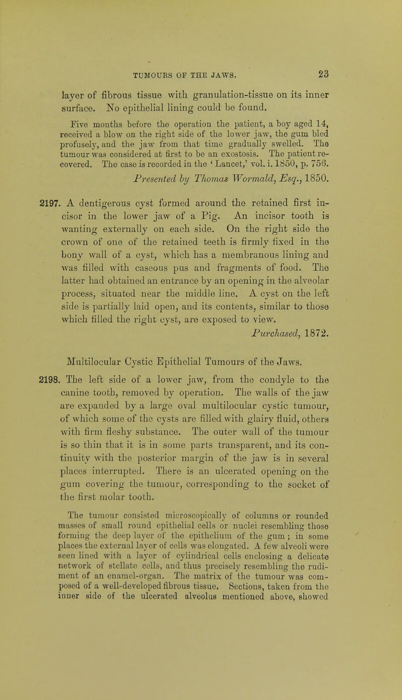 layer of fibrous tissue with granulation-tissue on its inner surface. No epithelial lining could be found. Five months before the operation the patient, a boy aged 14, received a blow on the right side of the lower jaw, the gum bled profusel}', and the jaw from that time gradually swelled. The tumour was considered at first to bo an exostosis. The patient re- covered. The case is recorded in the ' Lancet,' vol. i. 1850, p. 756. Fresented by Thomas Wormald, Esq., 1850. 2197. A dentigerous cyst formed around the retained first in- cisor in the lower jaw of a Pig. An incisor tooth is wanting externally on each side. On the right side the crown of one of the retained teeth is firmly fixed in the bony wall of a cyst, which has a membranous lining and was filled with caseous pus and fragments of food. The latter had obtained an entrance by an opening in the alveolar process, situated near the middle line. A cyst on the left side is partially laid open, and its contents, similar to those which filled the right cyst, are exposed to view. Fur chased, 1872. Multilocular Cystic Epithelial Tumours of the Jaws. 2198. The left side of a lower jaw, from the condyle to the canine tooth, removed by operation. The walls of the jaw are expanded by a large oval multilocular cystic tumour, of which some of the cysts are filled with glairy fluid, others with firm fleshy substance. The outer wall of the tumour is so thin that it is in some parts transparent, and its con- tinuity with the posterior margin of the jaw is in several places interrupted. There is an ulcerated opening on the gum covering the tumour, corresponding to the socket of the first molar tooth. The tumour consisted microscopically of columns or rounded masses of small round epithelial cells or nuclei resembling those forming the deep layer of the epithelium of the gum ; in some places the external layer of cells was elongated. A few alveoli were seen lined with a layer of cylindrical cells enclosing a delicate network of stellate colls, and thus precisely resembling the rudi- ment of an enamel-organ. The matrix of the tumour was com- posed of a well-developed fibrous tissue. Sections, taken from the inner side of the ulcerated alveolus mentioned above, showed