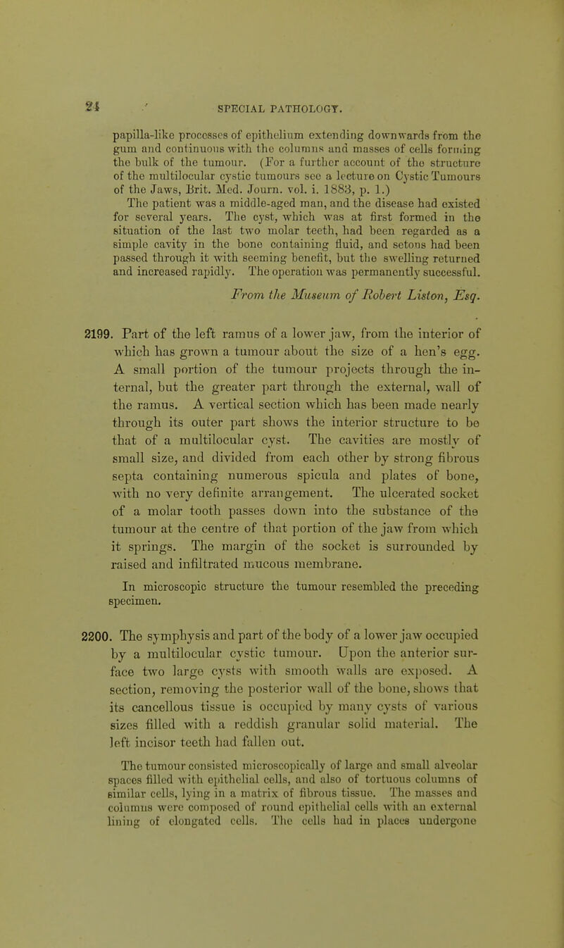 papilla-like processes of epithelium extending downwards from the gum and continuous with the columns and masses of cells forming the bulk of the tumour. (For a further account of the structure of the multilocular cystic tumours see a lecture on Cystic Tumours of the Jaws, I3rit. Med. Journ. vol. i. 1883, p. 1.) The patient was a middle-aged man, and the disease had existed for several years. The cyst, which was at first formed in the situation of the last two molar teeth, had been regarded as a simple cavity in the bono containing fluid, and setous had been passed, through it with seeming benefit, but the swelling returned and increased rapidly. The operation was permanentlj'^ successful. From the Museum of Eohei't Liston, Esq. 2199. Part of the left ramus of a lower jaw, from the interior of which has grown a tumour about the size of a hen's egg. A small portion of the tumour projects through the in- ternal, but the greater part through the external, wall of the ramus. A vertical section which has been made nearly through its outer part shows the interior structure to be that of a multilocular cyst. The cavities are mostly of small size, and divided from each other by strong fibrous septa containing numerous spicula and plates of bone, with no very definite arrangement. The ulcerated socket of a molar tooth passes down into the substance of the tumour at the centre of that portion of the jaw from which it springs. The margin of the socket is surrounded by raised and infiltrated mucous membrane. In microscopic structure the tumour resembled the preceding specimen. 2200. The symphysis and part of the body of a lower jaw occupied by a multilocular cystic tumour. Upon the anterior sur- face two largo cysts with smooth walls are exposed. A section, removing the posterior wall of the bone, shows that its cancellous tissue is occupied by many cysts of various sizes filled with a reddish granular solid material. The left incisor teeth had fallen out. The tumour consisted microscopically of large and small alveolar spaces filled with epithelial cells, and also of tortuous columns of similar cells, lying in a matrix of fibrous tissue. The masses and columns were composed of round epithelial cells wnth an external lining of elongated cells. The cells had in places uudergone