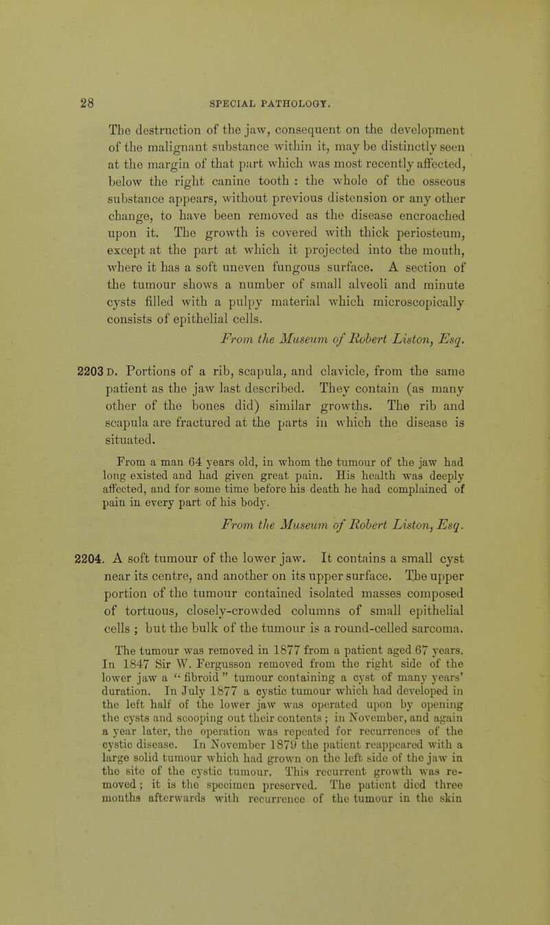 The destruction of the jaw, consequent on the development of the malignant substance within it, may be distinctly seen at the margin of that part which was most recently affected, below the right canine tooth : the whole of the osseous substance appears, without previous distension or any other change, to have been removed as the disease encroached upon it. The growth is covered with thick periosteum, except at the part at which it projected into the mouth, where it has a soft uneven fungous surface. A section of the tumour shows a number of small alveoli and minute cysts filled with a pulpy material which microscopically consists of epithelial cells. From the Museum of Robert Liston, Esq. 2203 D. Portions of a rib, scapula, and clavicle, from the same patient as the jaw last described. They contain (as many other of the bones did) similar growths. The rib and scapula are fractured at the parts in which the disease is situated. From a man 64 years old, in whom the tumour of the jaw had long existed and had given great pain. His health was deeply affected, and for some time before his death he had complained of pain in every part of his body. From the Museum of Robert Liston, Esq. 2204. A soft tumour of the lower jaw. It contains a small cyst near its centre, and another on its upper surface. The upper portion of the tumour contained isolated masses composed of tortuous, closely-crowded columns of small epithelial cells ; but the bulk of the tumour is a round-celled sarcoma. The tumour was removed in 1877 from a patient aged 67 years. In 1847 Sir W. Fergusson removed from the right side of the lower jaw a fibroid tumour containing a cyst of many years' duration. In July 1877 a cystic tumour which had developed in the left half of the lower jaw was operated upon by opening the cysts and scooping out their contents ; in November, and again a year later, the operation was repeated for recurrences of the cystic disease. In November 1870 the patient reappeared with a large solid tumour which had grown on the left side of the jaw in the site of the cystic tumour. This recurrent growth was re- moved ; it is the specimen preserved. The patient died three months afterwards with recurrence of the tumour in the skin