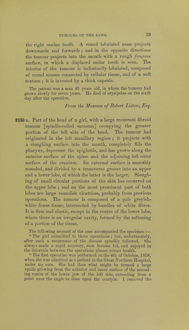the right canine tooth. A round lobulated mass projects downwards and forwards ; and in the opposite directions the tumour projects into the mouth with a rough fungous surface, in which a displaced molar tooth is seen. The interior of the tumour is indistinctly lobulated, composed of round masses connected by cellular tissue, and of a soft texture ; it is invested by a thick capsule. The patient was a man 45 years old, in whom the tumour had grown slowly for seven years. He died of erysipelas on the sixth day after the operation. From the Museum of Robert Liston, Esq. 2230 A. Part of the head of a girl, with a large recurrent fibroid tumour [spindle-celled sarcoma] occupying the greater portion of the left side of the head. The tumour had originated in the left maxillary region ; it projects with a sloughing surface into the mouth, completely fills the pharynx, depresses the epiglottis, and has grown along the anterior surface of the spine and the adjoining left outer surface of the cranium. Its external surface is smoothly rounded, and divided by a transverse groove into an upper and a lower lobe, of which the latter is the larger. Slough- ing of small circular portions of the skin has occurred on the upper lobe ; and on the most prominent part of both lobes are large roundish cicatrices, probably from previous operations. The tumour is composed of a pale greyish- white dense tissue, intersected by bundles of white fibres. It is firm and elastic, except in the centre of the lower lobe, where there is an irregular cavity, formed by the softening of a portion of the tissue. The following account of the case accompanied the specimen:—  The girl submitted to three operations ; but, unfortunately, after each a recurrence of the disease speedily followed. She always made a rapid recovery, soon became f;it, and enjoyed in the intervals between the operations almost robust health.  The first operation was performed on the 4th of October, 1858, when she was admitted as a patient in the Great Northern Hospital, under my care. She had then what might be termed a large epulis growing from the anterior and inner surface of the ascend- ing ramus of the lower jaw of the lot't side, extending from a point near the angle to close upon the condyle, i removed the