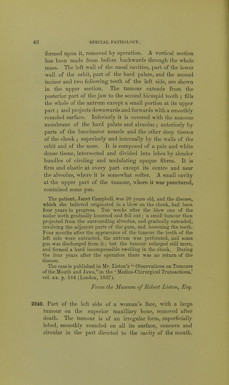 formed upon it, removed by operation. A vertical section has been made from before backwards through the whole mass. The left M'all of the nasal cavities, part of the lower wall of the orbit, part of the hard palate, and the second incisor and two following teeth of the left side, are shown in the upper section. The tumour extends from the posterior part of the jaw to the second bicuspid tooth ; fills the whole of the antrum except a small portion at its upper part ; and projects downwai-ds and forwards with a smoothly rounded surface. Inferiorly it is covered with the mucous membrane of the hard palate and alveolus ; anteriorly by parts of the buccinator muscle and the other deep tissues of the cheek ; superiorly and internally by the walls of the orbit and of the nose. It is composed of a pale and white dense tissue, intersected and divided into lobes by slender bundles of circling and undulating opaque fibres. It is firm and elastic at every part except its centre and near the alveolus, where it is somewhat softer. A small cavity at the upper part of the tumour, where it was punctured, contained some pus. The patient, Janet Campbell, was 26 years old, and the disease, which she believed originated in a blow on the cheek, had been four years in progress. Ten weeks after the blow one of the molar teeth gradually loosened and fell out; a small tumour then projected from the surrounding alveolus, and gradually extended, involving the adjacent parts of the gum, and loosening the teeth. Four months after the appearance of the tumour the teeth of the left side were extracted, the antrum was perforated, and some pus was discharged from it; but the tumour enlarged still more, and formed a hard incompressible swelling in the cheek. During the four years after the operation there was no return of the disease. The case is published in Mr. Liston's  Observations on Tumours of the Mouth aud Jaws, in the ' Medico-Chirurgical Transactions,' vol. XX. p. 184 (London, 1837). From the Museum of Robert Liston, Esq. 2240. Part of the left side of a woman's face, with a large tumour on the superior maxillary bone, removed after death. The tumour is of an irregular form, superficially lobed, smoothly rounded on all its surface, concave and circular in the part directed to the cavity of the mouth.