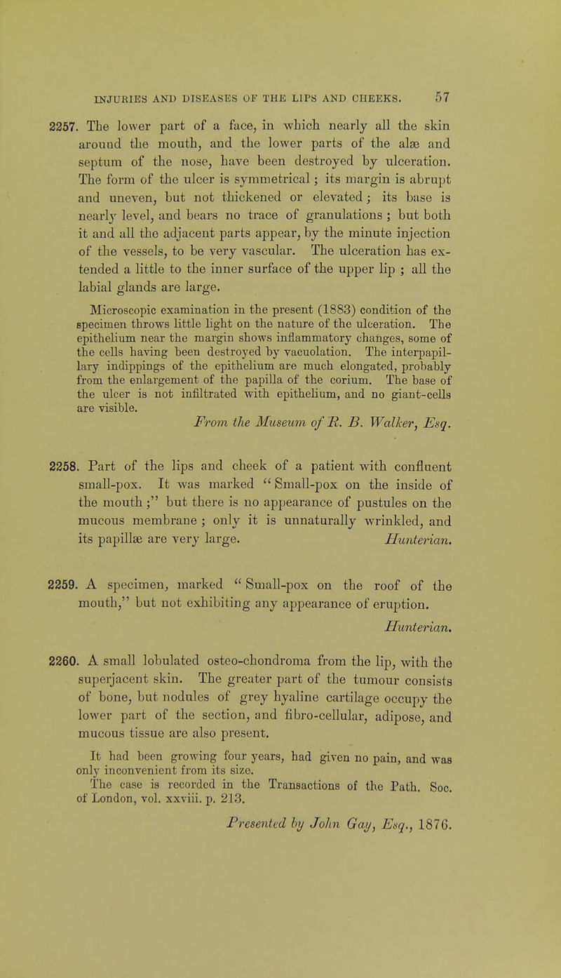 2257. The lower part of a face, in winch nearly all the skin around the mouth, and the lower parts of the alse and septum of the nose, have been destroyed by ulceration. The form of the ulcer is symmetrical; its margin is abrupt and uneven, but not thickened or elevated; its base is nearly level, and bears no trace of granulations ; but both it and all the adjacent parts appear, by the minute injection of the vessels, to be very vascular. The ulceration has ex- tended a little to the inner surface of the upper lip ; all the labial glands are large. Microscopic examination in the present (1883) condition of the specimen throws httle hght on the nature of the ulceration. The epithehum near the margin shows inflammatory changes, some of the cells having been destroyed by vacuolation. The interpapil- lary indippings of the epithelium are much elongated, probably from the enlargement of the papilla of the corium. The base of the ulcer is not infiltrated with epithehum, and no giant-ceUs are visible. From the Museum of 'R. B. Walker, Esq. 2258. Part of the lips and cheek of a patient with confluent small-pox. It was marked  Small-pox on the inside of the mouth; but there is no appearance of pustules on the mucous membrane ; only it is unnaturally wrinkled, and its papillae are very large. Uunterian. 2259. A specimen^ marked  Small-pox on the roof of the mouth, but not exhibiting any appearance of eruption. Hunterian. 2260. A small lobulated osteo-chondroma from the lip, with the superjacent skin. The greater part of the tumour consists of bone, but nodules of grey hyaline cartilage occupy the lower part of the section, and fibro-cellular, adipose, and mucous tissue are also present. It had been growing four years, had given no pain, and was only inconvenient from its size. The case is recorded in the Transactions of the Path. Soc. of London, vol. xxviii. p. 213. Presented by John Gay, Esq., 1876.