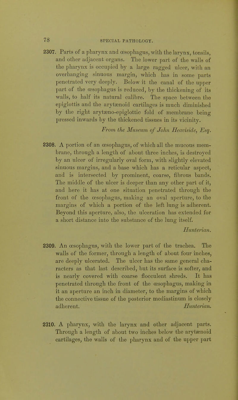 2307. Parts of a pharynx and oesophagus, with the larynx, tonsils, and other adjacent organs. The lower part of the walls of the pharynx is occupied by a large ragged ulcer, with an overhanging sinuous margin, which has in some parts penetrated very deeply. Below it the canal of the upper part of the oesophagus is reduced, by the thickening of its walls, to half its natural calibre. The space between the epiglottis and the aryta3noid cartilages is much diminished by the right aryt£eno-epiglottic fold of membrane being pressed inwards by the thickened tissues in its vicinity. 'om the Miiseum of John Heaviside, Esq. 2308. A portion of an oesophagus, of which all the mucous mem- brane, through a length of about three inches, is destroyed by an ulcer of irregularly oval form, with slightly elevated sinuous margins, and a base which has a reticular aspect, and is intersected by prominent, coarse, fibrous bands. The middle of the ulcer is deeper than any other part of it, and here it has at one situation penetrated through the front of the oesophagus, making an oval aperture, to the margins of which a portion of the left lung is adherent. Beyond this aperture, also, the ulceration has extended for a short distance into the substance of the lung itself. Huntenan. 2309. An oesophagus, with the lower part of the trachea. The walls of the former, through a length of about four inches, are deeply ulcerated. The ulcer has the same general cha- racters as that last described, but its surface is softer, and is nearly covered with coarse flocculent shreds. It has penetrated through the front of the oesophagus, making in it an aperture an inch in diameter, to the margins of which the connective tissue of the posterior mediastinum is closely adherent. Hunterian. 2310, A pharynx, with the larynx and other adjacent parts. Through a length of about two inches below the arytaenoid cartilages, the walls of the pharynx and of the upper part