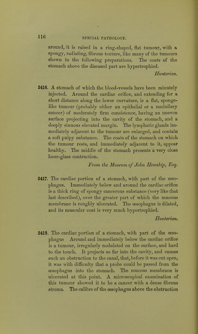 around, it is raised in a ring-shaped, flat tumour, with a spongy, radiating, fibrous texture, like many of the tumours shown in the following preparations. The coats of the stomach above the diseased part are hypertrophied. Hunterian. 2416. A stomach of which the blood-vessels have been minutely injected. Around the cardiac orifice, and extending for a short distance along the lower curvature, is a flat, sponge- like tumour (probably either an epithelial or a medullary cancer) of moderately firm consistence, having an uneven surface projecting into the cavity of the stomach, and a deeply sinuous elevated mtirgin. The lymphatic glands im- mediately adjacent to the tumour are enlarged, and contain a soft pulpy substance. The coats of the stomach on which the tumour rests, and immediately adjacent to it, appear healthy. The middle of the stomach presents a very close hour-glass contraction. From the Museum of John Hoicship, Esq. 2417. The cardiac portion of a stomach, with part of the oeso- phagus. Immediately below and around the cardiac orifice is a thick ring of spongy cancerous substance (very like that last described), over the greater part of which the mucous membrane is roughly ulcerated. The oesophagus is dilated, and its muscular coat is very much hypertrophied. Hunterian. 2418. The cardiac portion of a stomach, with part of the oeso- phagus Around and immediately below the cardiac orifice is a tumour, irregularly nodulated on the surface, and hard to the touch. It projects so far into the cavity, and causes such an obstruction to the canal, that, before it was cut open, it was with difficulty that a probe could be passed from the oesophagus into the stomach. The mucous membrane is ulcerated at this point. A microscopical examination of this tumour showed it to be a cancer with a dense fibrous stroma. The calibre of the oesophagus above the obstruction