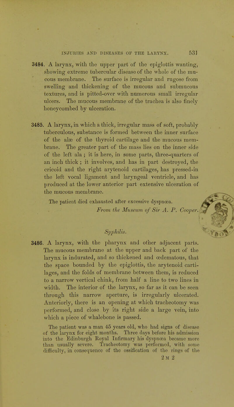 3484. A larynx, with the upper part of the epiglottis wanting, showing extreme tubercular disease of the whole of the mu- cous membrane. The surface is irregular and rugose from swelling and thickening of the mucous and submucous textures, and is pitted-over with numerous small irregular ulcers. The mucous membrane of the trachea is also finely honeycombed by ulceration. 3485. A larynx, in which a thick, irregular mass of soft, probably tuberculous, substance is formed between the inner surface of the alse of the thyroid cartilage and the mucoids mem- brane. The greater part of the mass lies on the inner side of the left ala ; it is here, in some parts, three-quarters of an inch thick ; it involves, and has in part destroyed, the cricoid and the right arytenoid cartilages, has pressed-in the left vocal ligament and laryngeal ventricle, and has produced at the lower anterior part extensive ulceration of the mucous membrane. The patient died exhausted after excessive dyspnoea. From the Museum of Sir A. P. Cooper./ i Syphilis. 3486. A larynx, with the pharynx and other adjacent parts. The mucous membrane at the upper and back part of the larynx is indurated, and so thickened and oedematous, that the space bounded by the epiglottis, the arytenoid carti- lages, and the folds of membrane between them, is reduced to a narrow vertical chink, from half a line to two lines in \A'idth. The interior of the larynx, so far as it can be seen through this narrow aperture, is irregularly ulcerated. Anteriorly, there is an opening at which tracheotomy was performed, and close by its right side a large vein, into which a piece of whalebone is passed. The patient was a man 45 years old, who had signs of disease of the larynx for eight months. Three days before his admission into the Edinburgh Royal Infirmary his dyspncca became more than usually severe. Tracheotomy was performed, with some difficulty, in consequence of the ossification of the rings of tlio 2m 2
