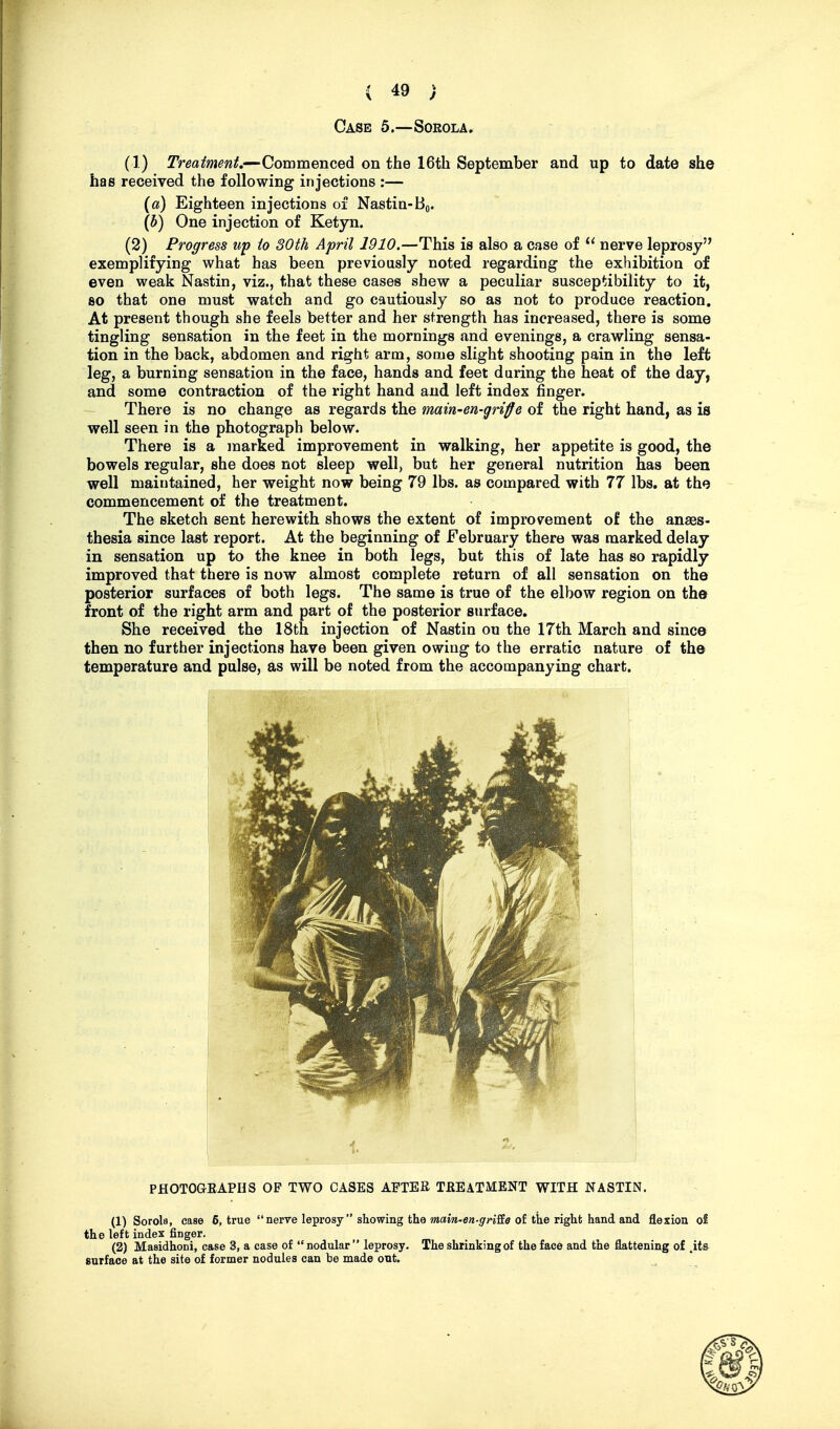 Case 5.—Sorola. (1) Treatment.—^Commenced on the 16th September and up to date she has received the following injections :— (a) Eighteen injections of Nastin-Bo. (b) One injection of Ketyn. (2) Progress up to 30th April 1910.—This is also a case of nerve leprosy exemplifying what has been previously noted regarding the exhibition of even weak Nastin, viz., that these cases shew a peculiar susceptibility to it, so that one must watch and go cautiously so as not to produce reaction. At present though she feels better and her strength has increased, there is some tingling sensation in the feet in the mornings and evenings, a crawling sensa- tion in the back, abdomen and right arm, soaie slight shooting pain in the left leg, a burning sensation in the face, hands and feet during the heat of the day, and some contraction of the right hand and left index finger. There is no change as regards the main-en-griffe of the right hand, as is well seen in the photograph below. There is a marked improvement in walking, her appetite is good, the bowels regular, she does not sleep well, but her general nutrition has been well maintained, her weight now being 79 lbs. as compared with 77 lbs. at the commencement of the treatment. The sketch sent herewith shows the extent of improvement of the anaes- thesia since last report. At the beginning of February there was marked delay in sensation up to the knee in both legs, but this of late has so rapidly improved that there is now almost complete return of all sensation on the posterior surfaces of both legs. The same is true of the elbow region on the front of the right arm and part of the posterior surface. She received the 18fch injection of Nastin on the 17th March and since then no further injections have been given owing to the erratic nature of the temperature and pulse, as will be noted from the accompanying chart. PHOTOGEAPHS OP TWO CASES AFTEE TBEATMENT WITH NASTIN. (1) Sorola, case 6, true  nerve leprosy  showing the »»am-e»-.9'Wffa of the right hand and flexion of the left index finger. (2) Masidhoni, case 3, a case of nodular leprosy. The shrinking of the face and the flattening of ,it& surface at the site of former nodules can be made out.