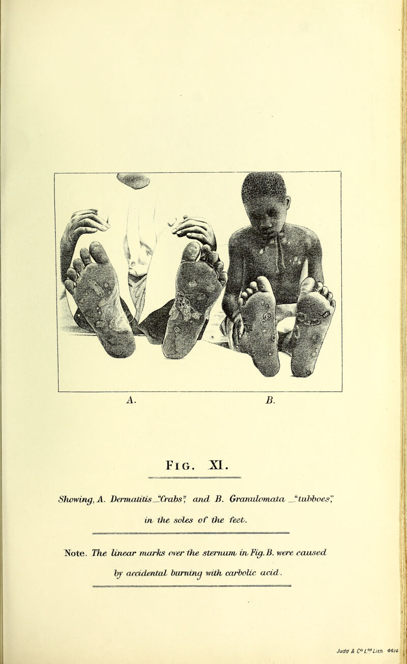 A. B. Fig. Showing, A. Dermatitis^Ct'obs^l '^^'^ ^- GrojcuhmatcL _J!Li]diboes'^ irv the soles of the feet. ^ote. The linear nuirks over ihe stemunv in Fig. B. were caused ~bY (u-ddrntal hwrmnn with carbolic acid .