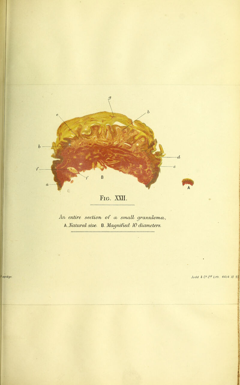 An entire seoUorv of cv smaJJb grajtuLonuv, A.JfaturalySue'. B. McLgnified JO diameters.