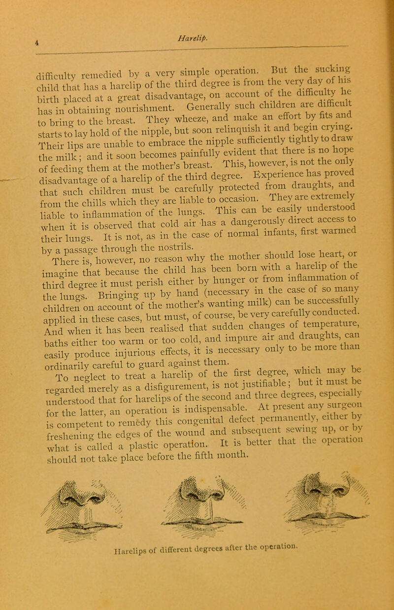 difficulty remedied by a very simple operation. But the sucking child that has a harelip of the third degree is from birth placed at a great disadvantage, on account of the “ has in obtaining noiirisliineiit Generally such children ar to briim to the breast. They wheeze, and make an effort by fits and starts to lay hold of the nipple, but soon relinquish it and begin crying. Their lips are unable to embrace the nipple sufficiently tightly to draw the millf- and it soon becomes painfully evident that there is no hop of feriiui Lm at the mother's breast This, however, is not the only disadvantage of a harelip of the third degree. Experience has proved that such children must be carefully protected from draughts, and frot the chills which they are liable to occasion. They are extremely iSbL to inflamniatioii of the lungs. This can be easily when it is observed that cold air has a ^ their lungs. It is not, as in the case of normal infants, first warmed the mother should lose hean, or imagine that because the child has been born with a harelip of the third degree it must perish either by hunger or from inflammation of the lungs. Bringing up by hand (necessary in the case of so mai y children on account of the mother’s wanting milk) can be successfu y annlied irthese cases, but must, of course, be very carefully conducted. Anl when it has been realised that sudden changes f temperature baths either too warm or too cold, and impure air and draughts cai easily produce injurious effects, it is necessary only to be more than nrfliniirilv C3,rcfiil to 3,g3.inst tlicixi. i . i ^ CnevlS to treS a harelip of the first degree, which may be regarded°inerely as a disfigurement, is not justifiable; but it must be understood that for harelips of the second and three degrees, espec.alh for tl Hatrer, an operation is indispensable. At present any ^irgeoii [rclpetent to reniedy this congenital defect permanently, either by freshening the edges of the wound and subsequent .sew mg up, . wharis cdtd a “plastic operation. It is better that the operation should not take place before the fifth mouth. Harelips of differeut degrees after the operation.