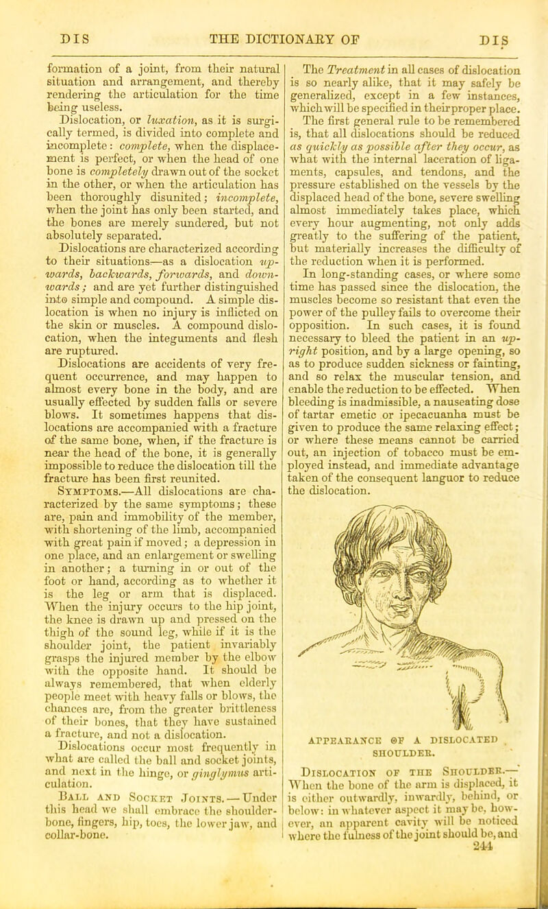 formation of a joint, from their natural situation and arrangement, and thereby rendering the articulation for the time being useless. Dislocation, or luxation, as it is surgi- cally termed, is divided into complete and incomplete: complete, when the displace- ment is perfect, or when the head of one bone is completely di-awnoutof the socket in the other, or when the articulation has been thoroughly disunited; incomplete, when the joint has only been started, and the bones are merely simdered, but not absolutely separated. Dislocations are characterized according to their situations:—as a dislocation up- wards, backwards, forwards, and doiun- wards ; and are yet fm-ther distinguished ini© simple and compound. A simple dis- location is when no injury is inflicted on the skin or muscles. A compound dislo- cation, when the integuments and flesh are ruptured. Dislocations are accidents of very fre- quent occurrence, and may happen to almost every bone in the body, and are usually effected by sudden falls or severe blows. It sometimes happens that dis- locations are accompanied with a fracture of the same bone, when, if the fracture is near the head of the bone, it is generally impossible to reduce the dislocation till the fracture has been first reunited. Symptoms.—All dislocations are cha- racterized by the same symptoms; these are, pain and immobility of the member, with shortening of the limb, accompanied with great pain if moved; a depression in one place, and an enlargement or swelling in another; a tiuming in or out of the foot or hand, according as to whetlier it is the leg or arm that is displaced. When the injury occurs to the hip joint, the knee is drawn up and pressed on the thigh of the soimd leg, while if it is the shoulder joint, the patient invariably grasps the injm’ed member by the elbow with the opposite hand. It should be always remembered, that when elderly people meet with heavy falls or blows, the chances are, from the greater brittleness of their bones, that they have sustained a fracture, and not a dislocation. Dislocations occur most frequently in what are called the ball and socket joints, and next in the hinge, or c/iufflynu^s arti- culation. Dall and Socket Joints. — Under tliis head we shall embrace the shoulder- bone, lingers, hip, toes, the lower jaw, and | collar-bone. i The Treatment in aU cases of dislocation is so nearly alike, that it may safely be generahzed, except in a few instances, which will be specified in theirproper place. The first general rule to be remembered is, that all dislocations should be reduced as quickly as possible after they occur, as what with the internal laceration of liga- ments, capsules, and tendons, and the pressm'e established on the vessels by the displaced head of the bone, severe swelling almost immediately takes place, which every hour augmenting, not only adds greatly to the suffering of the patient, but materially increases the difficulty of the reduction when it is performed. In long-standing cases, or where some time has passed since the dislocation, the muscles become so resistant that even the power of the pulley fails to overcome their opposition. In such cases, it is found necessary to bleed the patient in an up- right position, and by a large opening, so as to produce sudden sickness or fainting, and so relax the muscular tension, and enable the reduction to be effected. When bleeding is inadmissible, a nauseating dose of tartar emetic or ipecacuanha must be given to produce the same relaxing effect; or where these means cannot be carried out, an injection of tobacco must be em- ployed instead, and immediate advantage taken of the consequent languor to reduce the dislocation. ArrEAKANCE ©F A DISLOCATED SIIODLDEE. Dislocation of the SnouLDER.— H^hen the bone of the arm is displaced, it is either outwardly, inwardly, behind, or below: in whatever aspect it may be, how- ever, an apparent cavity will be noticed where the fulness of the joint should be, and