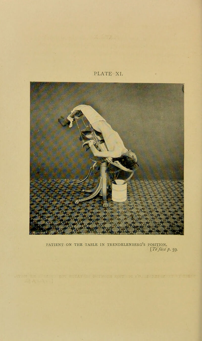 PATIENT ON THE TABLE IN TRENDELENBERG’S POSITION. [To face p. 59.