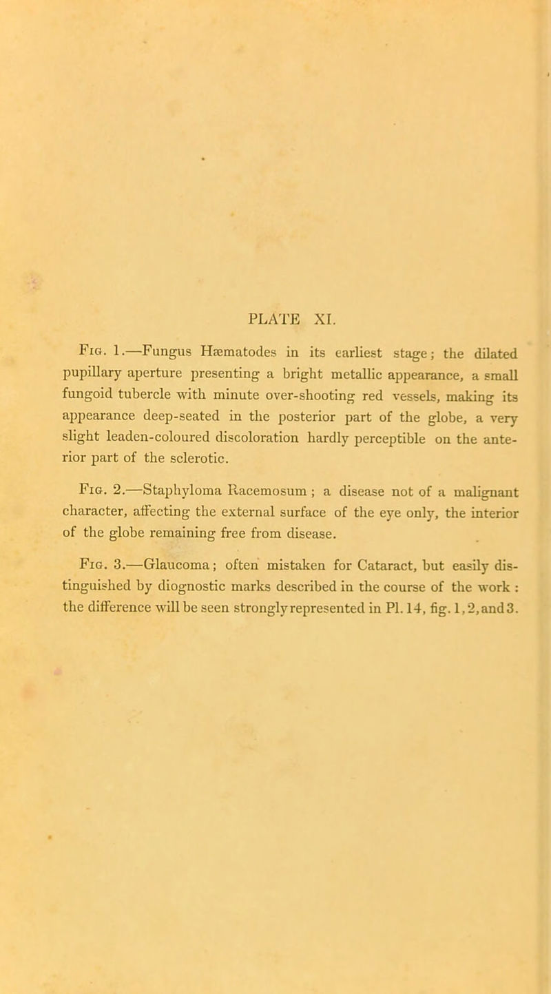Fig. 1.—Fungus Hmmatodes in its earliest stage; the dilated pupillary aperture presenting a bright metallic appearance, a small fungoid tubercle with minute over-shooting red vessels, making its appearance deep-seated in the posterior part of the globe, a very slight leaden-coloured discoloration hardly perceptible on the ante- rior part of the sclerotic. Fig. 2.—Staphyloma Racemosum; a disease not of a malignant character, affecting the external surface of the eye only, the interior of the globe remaining free from disease. Fig. 3.—Glaucoma; often mistaken for Cataract, but easily dis- tinguished by diognostic marks described in the course of the work : the difference will be seen strongly represented in PI. 14, fig. I,2,and3.