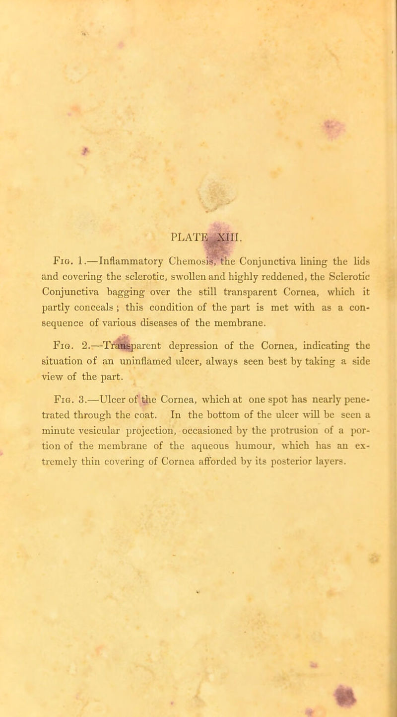 Fig. 1.—Inflammatory ChemosisT’the Conjunctiva lining the lids and covering the sclerotic, swollen and highly reddened, the Sclerotic Conjunctiva bagging over the still transparent Cornea, which it partly conceals ; this condition of the part is met with as a con- sequence of various diseases of the membrane. Fig. 2.—Transparent depression of the Cornea, indicating the situation of an uninflamed ulcer, always seen best by taking a side view of the part. Fig. 3.—Ulcer of the Cornea, which at one spot has nearly pene- trated through the coat. In the bottom of the ulcer will be seen a minute vesicular projection, occasioned by the protrusion of a por- tion of the membrane of the aqueous humour, which has an ex- tremely thin covering of Cornea afforded by its posterior layers.