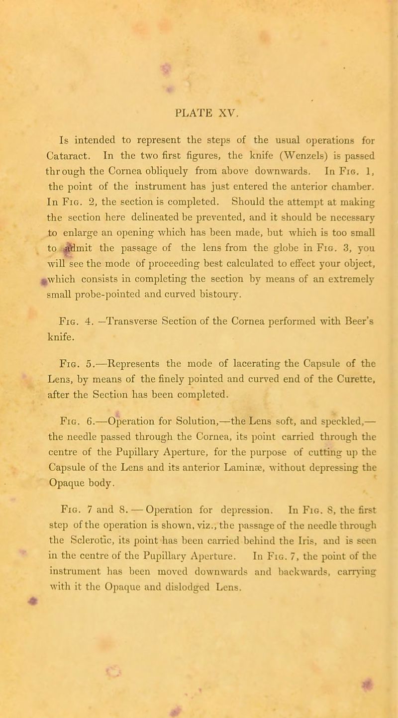 Is intended to represent the steps of the usual operations for Cataract. In the two first figures, the knife (Wenzels) is passed thr ough the Cornea obliquely from above downwards. In Fig. 1, the point of the instrument has just entered the anterior chamber. In Fig. 2, the section is completed. Should the attempt at making the section here delineated be prevented, and it should be necessary to enlarge an opening which has been made, but which is too small to a*dmit the passage of the lens from the globe in Fig. 3, you will see the mode of proceeding best calculated to effect your object, * which consists in completing the section by means of an extremely small probe-pointed and curved bistoury. Fig. 4. —Transverse Section of the Cornea performed with Beer’s knife. Fig. 5.—Represents the mode of lacerating the Capsule of the Lens, by means of the finely pointed and curved end of the Curette, after the Section has been completed. Fig. 6.—Operation for Solution,—the Lens soft, and speckled,— the needle passed through the Cornea, its point carried through the centre of the Pupillary Aperture, for the purpose of cutting up the Capsule of the Lens and its anterior Lamina}, without depressing the Opaque body. Fig. 7 and 8. — Operation for depression. In Fig. S, the first step of the operation is shown, viz., the passage of the needle through the Sclerotic, its point has been carried behind the Iris, and is seen in the centre of the Pupillary Aperture. In Fig. 7, the point of the instrument has been moved downwards and backwards, carrying with it the Opaque and dislodged Lens.