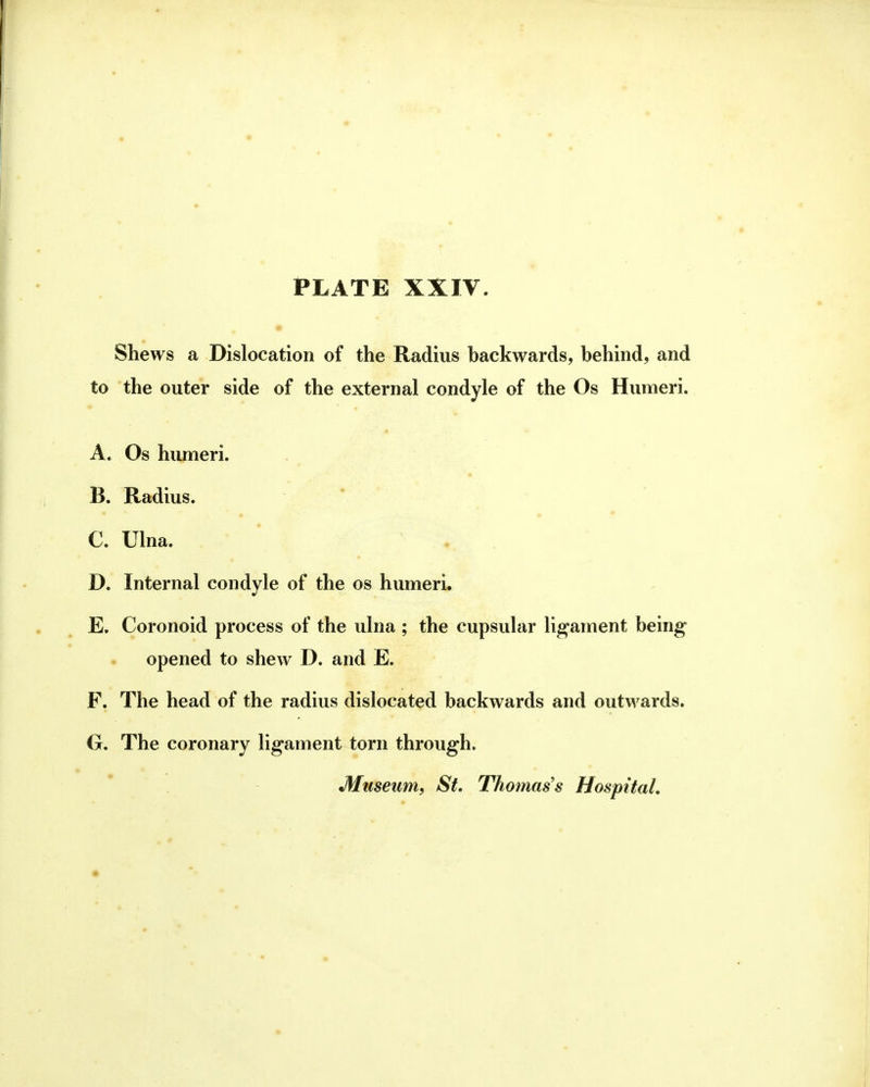 PLATE XXIV Shews a Dislocation of the Radius backwards, behind, and to the outer side of the external condyle of the Os Humeri. A. Os humeri. B. Radius. C. Ulna. D. Internal condyle of the os humeri. E. Coronoid process of the ulna ; the cupsular ligament being opened to shew D. and E. F. The head of the radius dislocated backwards and outwards. O. The coronary ligament torn through. Museum^ St, Thomas's Hospital,