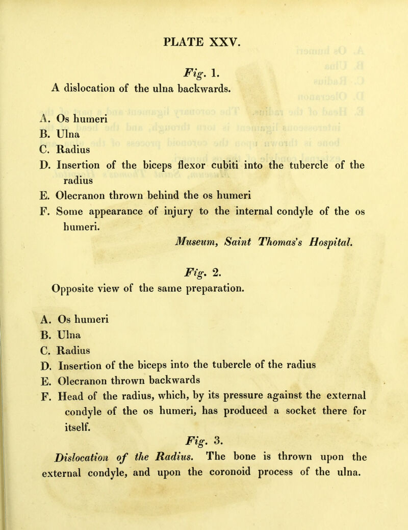 Fig. 1. A dislocation of the ulna backwards. A. Os humeri B. Ulna C. Radius D. Insertion of the biceps flexor cubiti into the tubercle of the radius E. Olecranon thrown behind the os humeri F. Some appearance of injury to the internal condyle of the os humeri. Museum, Saint Thomas's Hospital, Fig. 2. Opposite view of the same preparation. A. Os humeri B. Ulna C. Radius D. Insertion of the biceps into the tubercle of the radius E. Olecranon thrown backwards F. Head of the radius, which, by its pressure against the external condyle of the os humeri, has produced a socket there for itself. Fig. 3. Dislocation of the Radius. The bone is thrown upon the external condyle, and upon the coronoid process of the ulna.