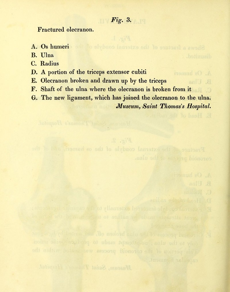 Fig. 3. Fractured olecranon. A. Os humeri B. Ulna C. Radius D. A portion of the triceps extensor cubiti E. Olecranon broken and drawn up by the triceps F. Shaft of the ulna where the olecranon is broken from it G. The new ligament, which has joined the olecranon to the ulna.