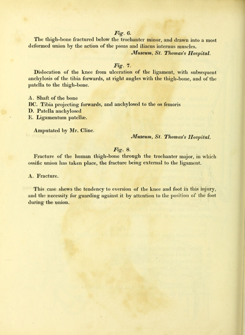 Fig. 6. The thigh-bone fractured below the trochanter minor, and drawn into a most deformed union by the action of the psoas and iliacus internus muscles. Museum, St. Thomas's Hospital. Fig. 7. Dislocation of the knee from ulceration of the ligament, with subsequent anchylosis of the tibia forwards, at ri^ht angles with the thigh-bone, and of the patella to the thigh-bone. A. Shaft of the bone BC. Tibia projecting forwards, and anchylosed to the os femoris D. Patella anchylosed \ E. Ligamentum patellae. Amputated by Mr. Cline, Museum, St. Thomas's Hospital. Fig. S. Fracture of the human thigh-bone through the trochanter major, in which ossific union has taken place, the fracture being external to the ligament. A. Fracture. This case shews the tendency to eversion of the knee and foot in this injury, and the necessity for guarding against it by attention to the position of the foot during the union.