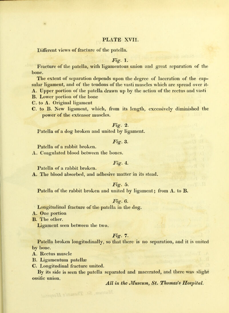 Different views of fracture of the patella. Fig. 1. Fracture of the patella, with ligamentous union and great separation of the bone. The extent of separation depends upon the degree of laceration of the cap- sular ligament, and of the tendons of the vasti muscles which are spread over it* A. Upper portion of the patella drawn up by the action of the rectus and vasti B. Lower portion of the bone C. to A. Original ligament C. to B. ISew ligament, which, from its length, excessively diminished the power of the extensor muscles. Fig. 2. Patella of a dog broken and united by ligament. Fig. 3. Patella of a rabbit broken. A. Coagulated blood between the bones. Fig. 4. Patella of a rabbit broken. A. The blood absorbed, and adhesive matter in its stead. Fig. 5. Patella of the rabbit broken and united by ligament; from A. to B. Fig. 6. Longitudinal fracture of the patella in the dog. A. One portion B. The other. Ligament seen between the two. Fig. 7. Patella broken longitudinally, so that there is no separation, and it is united by bone. A. Rectus muscle B. Ligamentum patellae C. Longitudinal fracture united. By its side is seen the patella separated and macerated, and there was slight ossific union. All in the Museum, St. Thomas's Hospital.