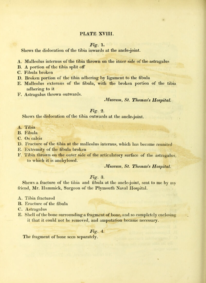 Fig. 1. Shews the dislocation of the tibia inwards at the ancle-joint. A. Malleolus internus of the tibia thrown on the inner side of the astragalus B. A portion of the tibia split oiF C. Fibula broken D. Broken portion of the tibia adhering by ligament to the fibula E. Malleolus externus of the fibula, with the broken portion of the tibia adhering to it F. Astragalus thrown outwards. Museum, St. Thomas's Hospital. Fig. 2. Shews the dislocation of the tibia outwards at the ancle-joint. A. Tibia B. Fibula C. Os calcis D. Fracture of the tibia at the malleolus internus, which has become reunited E. Extremity of the fibula broken F. Tibia thrown on the outer side of the articulatory surface of the astragalus, to which it is anchylosed. tMuseum, St. Thomas's Hospital. Fig. 3. Shews a fracture of the tibia and fibula at the ancle-joint, sent to me by my friend, Mr. Hammick, Surgeon of the Plymouth Naval Hospital. A. Tibia fractured B. Fracture of the fibula C. Astragalus E. Shell of the bone surrounding a fragment of bone, and so completely enclosing it that it could not be removed, and amputation became necessary. Fig. 4. The fragment of bone seen separately.