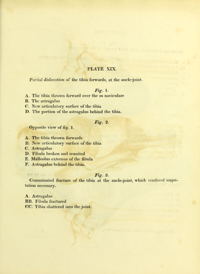 Partial dislocation of the tibia forwards, at the ancle-joint. Fig. 1. A. The tibia thrown forward over the os naviculare B. The astragalus C. New articulatory surface of the tibia D. The portion of the astragalus behind the tibia. Fig. 2. Opposite view of fig, 1. A. The tibia thrown forwards B. New articulatory surface of the tibia C. Astragalus D. Fibula broken and reunited E. Malleolus externus of the fibula F. Astragalus behind the tibia. Fig. 3. Comminuted fracture of the tibia at the ancle-joint, which rendered ampu- tation necessary. A. Astragalus BB. Fibula fractured CC. Tibia shattered into the joint.