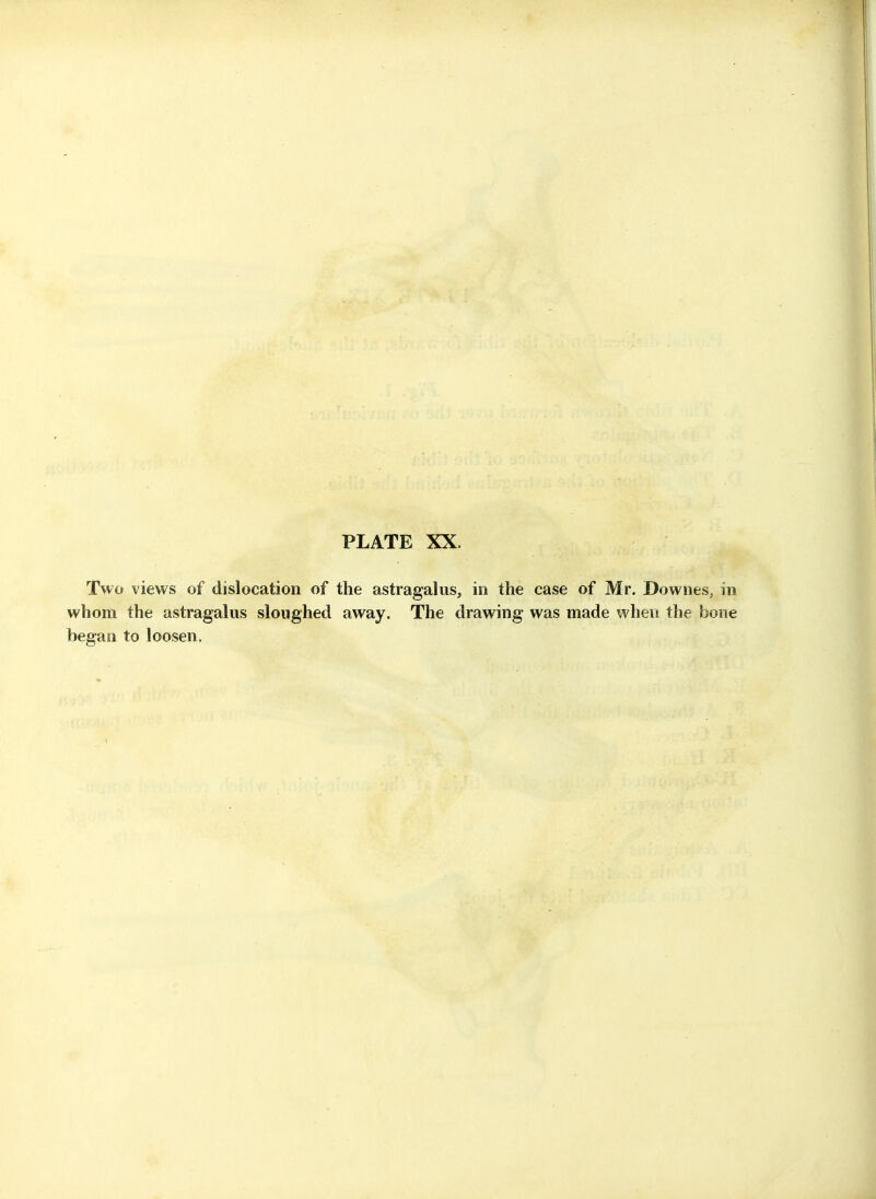 Two views of dislocation of the astragalus, in the case of Mr. Downes, in whom the astragalus sloughed away. The drawing was made when the bone began to loosen.