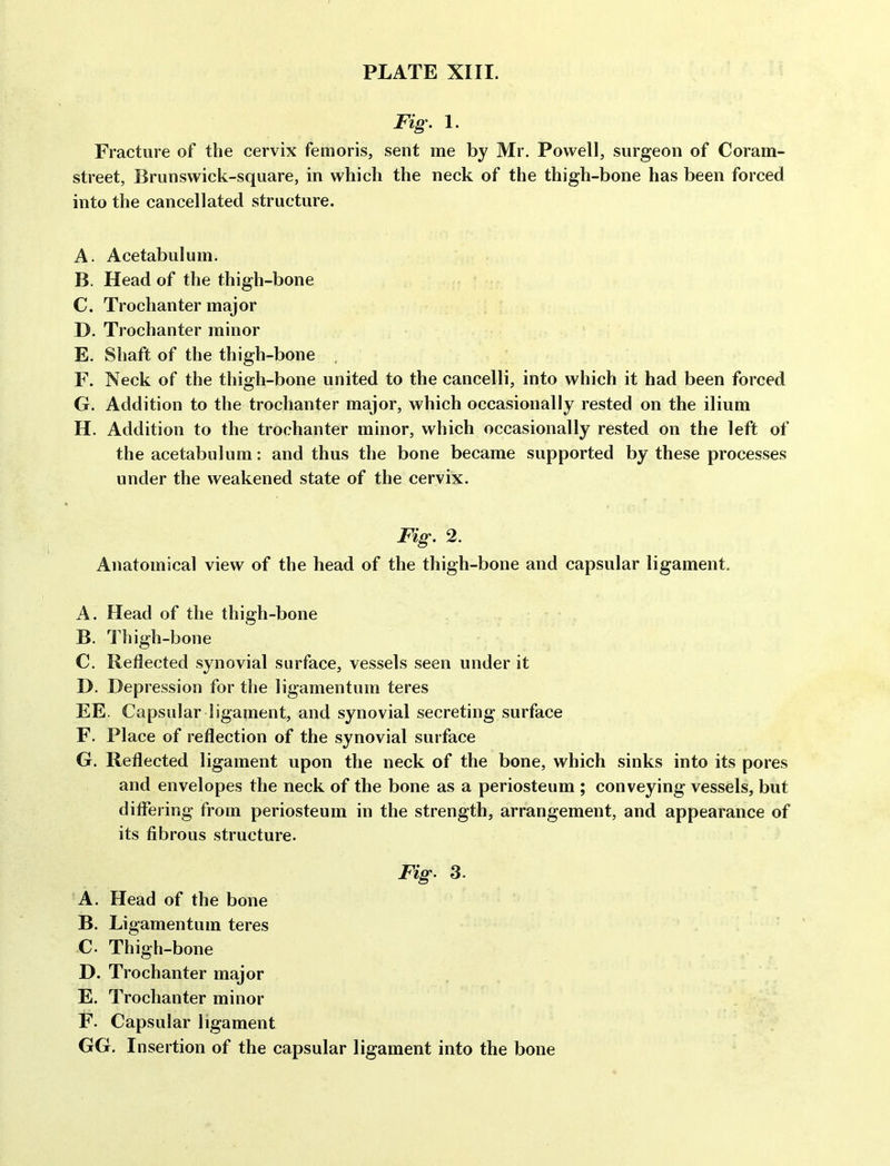 Fig' 1. Fracture of the cervix femoris, sent me by Mr. Powell, surgeon of Coram- street, Brunswick-square, in which the neck of the thigh-bone has been forced into the cancellated structure. A. Acetabulum. B. Head of the thigh-bone C. Trochanter major D. Trochanter minor E. Shaft of the thigh-bone . F. Neck of the thigh-bone united to the cancelli, into which it had been forced G. Addition to the trochanter major, which occasionally rested on the ilium H. Addition to the trochanter minor, which occasionally rested on the left of the acetabulum: and thus the bone became supported by these processes under the weakened state of the cervix. Fig. 2. Anatomical view of the head of the thigh-bone and capsular ligament. A. Head of the thigh-bone B. Thigh-bone C. Reflected synovial surface, vessels seen under it jy. Depression for the ligamentum teres EE. Capsular ligament, and synovial secreting surface F. Place of reflection of the synovial surface G. Reflected ligament upon the neck of the bone, which sinks into its pores and envelopes the neck of the bone as a periosteum ; conveying vessels, but difl'ering from periosteum in the strength, arrangement, and appearance of its fibrous structure. Fig. 3. A. Head of the bone B. Ligamentum teres C. Thigh-bone D. Trochanter major E. Trochanter minor F. Capsular ligament GG. Insertion of the capsular ligament into the bone