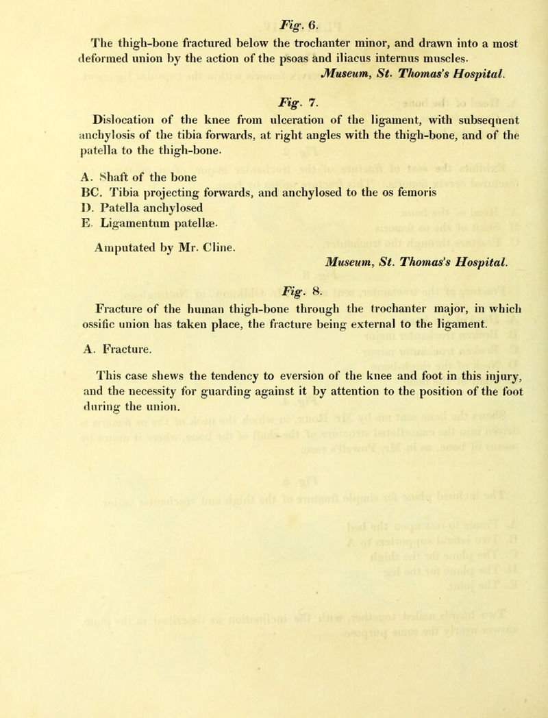 Fig. 6. The thigh-bone fractured below the trochanter minor, and drawn into a most deformed union by the action of the psoas and iliacus internus muscles. jyfuseum, St' Thomas's Hospital. Fig. 7. Dislocation of the knee from ulceration of the ligament, with subsequent anchylosis of the tibia forwards, at right angles with the thigh-bone, and of the patella to the thigh-bone. A. Shaft of the bone BC. Tibia projecting forwards, and anchylosed to the os femoris ]>, Patella anchylosed E. Ligamentum patellae. Amputated by Mr. Cline. Museum, St. Thomas's Hospital. Fig. 8. Fracture of the human thigh-bone through the trochanter major, in which ossific union has taken place, the fracture being external to the ligament. A. Fracture. This case shews the tendency to eversion of the knee and foot in this injury, and the necessity for guarding against it by attention to the position of the foot during the union.
