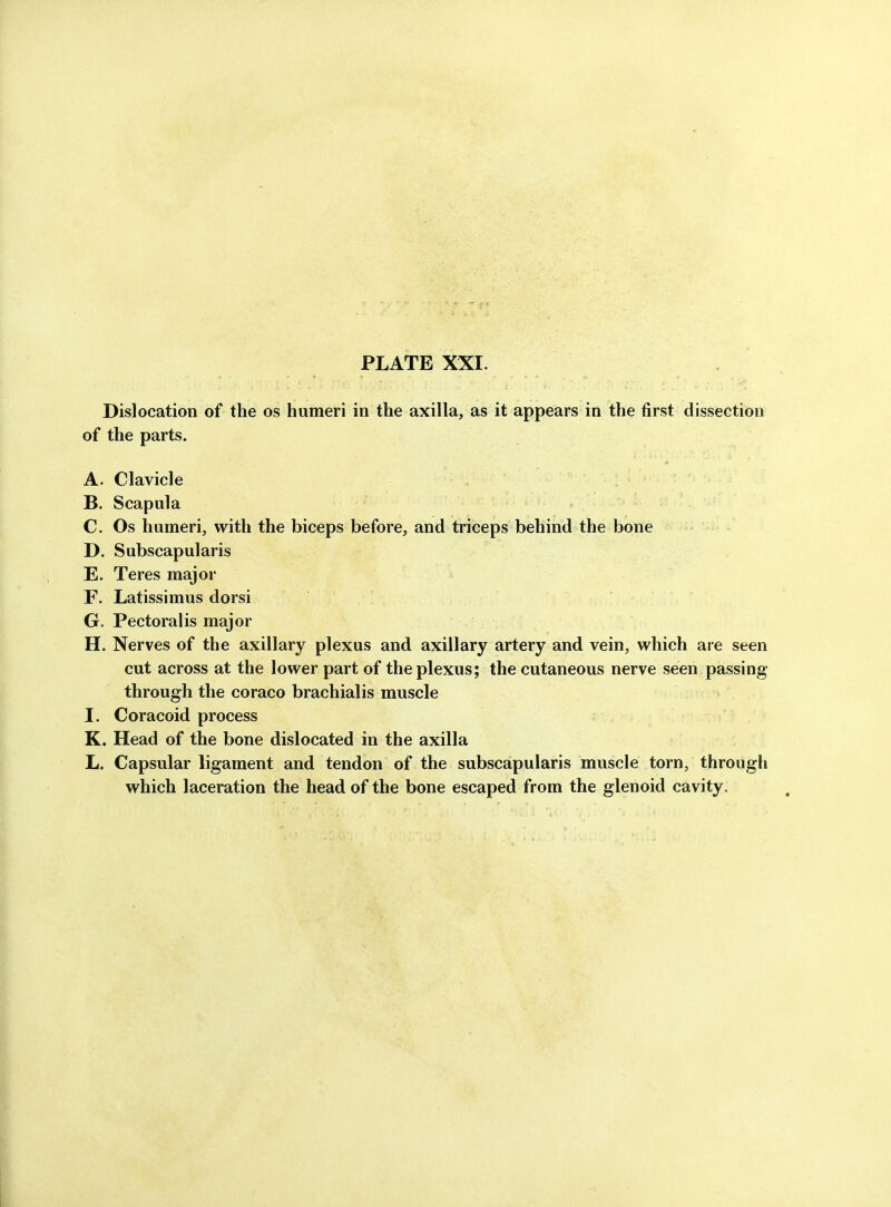 Dislocation of the os humeri in the axilla, as it appears in the first dissection of the parts. A. Clavicle B. Scapula C. Os humeri, with the biceps before, and triceps behind the bone D. Subscapularis E. Teres major F. Latissimus dorsi G. Pectoralis major H. Nerves of the axillary plexus and axillary artery and vein, which are seen cut across at the lower part of the plexus; the cutaneous nerve seen passing- through the coraco brachialis muscle I. Coracoid process K. Head of the bone dislocated in the axilla L. Capsular ligament and tendon of the subscapularis muscle torn, through which laceration the head of the bone escaped from the glenoid cavity.