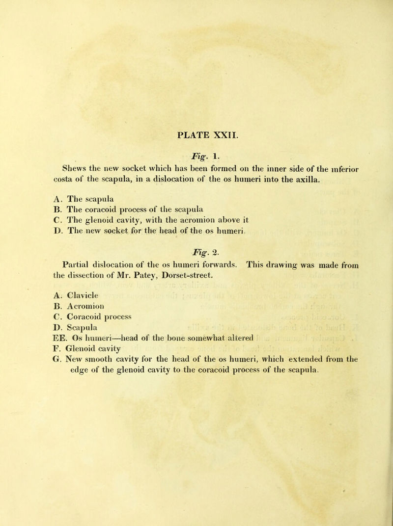 Fig'. 1. Shews the new socket which has been formed on the inner side of the inferior costa of the scapula, in a dislocation of the os humeri into the axilla. A. The scapula B. The coracoid process of the scapula C. The glenoid cavity, with the acromion above it D. The new socket for the head of the os humeri. Fig. 2. Partial dislocation of the os humeri forwards. This drawing was made from the dissection of Mr. Patey, Dorset-street. A. Clavicle B. Acromion C. Coracoid process D. Scapula EE. Os humeri—head of the bone somewhat altered F. Glenoid cavity G. New smooth cavity for the head of the os humeri, which extended from the edge of the glenoid cavity to the coracoid process of the scapula.