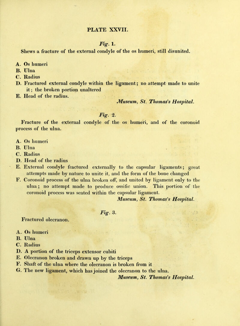 Fig. 1. Shews a fracture of the external condyle of the os humeri, still disunited. A. Os humeri , B. Ulna C. Radius D. Fractured external condyle within the ligament; no attempt made to unite it; the broken portion unaltered E. Head of the radius. Museum, St. Thomas's Hospital. Fig. 2. Fracture of the external condyle of the os humeri, and of the coronoid process of the ulna. A. Os humeri B. Ulna : C. Radius D. Head of the radius ' E. External condyle fractured externally to the capsular ligaments; great attempts made by nature to unite it, and the form of the bone changed F. Coronoid process of the ulna broken off, and united by ligament only to the ulna; no attempt made to produce ossific union. This portion of the coronoid process was seated within the capsular ligament. Museum, St. Thomas's Hospital. Fig. S. Fractured olecranon. A. Os humeri B. Ulna C Radius D. A portion of the triceps extensor cubiti E. Olecranon broken and drawn up by the triceps F. ^haft of the ulna where the olecranon is broken from it G. The new ligament, which has joined the olecranon to the ulna.