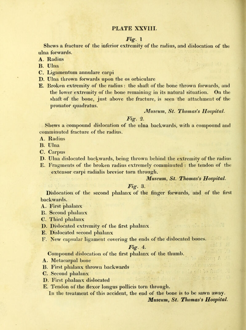 Fig. 1 Shews a fracture of the inferior extremity of the radius, and dislocation of the ulna forwards. A. Radius B. Ulna C. Ligamentum annulare carpi D. Ulna thrown forwards upon the os orbiculare E. Broken extremity of the radius : the shaft of the bone thrown forwards, and the lower extremity of the bone remaining in its natural situation. On the shaft of the bone, just above the fracture, is seen the attachment of the pronator quadratus. JHuseum, St. Thomas's Hospital. Fig. 2. Shews a compound dislocation of the ulna backwards, with a compound and comminuted fracture of the radius, A. Radius B. Ulna C. Carpus D. Ulna dislocated backwards, being thrown behind the extremity of the radius E. Fragments of the broken radius extremely comminuted : the tendon of the extensor carpi radialis brevior torn through. Museum, St. Thomas's Hospital. Fig. 3. Dislocation of the second phalanx of the finger forwards, and of the first backwards. A. First phalanx B. Second phalanx C. Third phalanx D. Dislocated extremity of the first phalanx E. Dislocated second phalanx F. New capsular ligament covering the ends of the dislocated bones. Fig. 4. Compound dislocation of the first phalanx of the thumb. A. Metacarpal bone B. First phalanx thrown backwards C. Second phalanx D. First phalanx dislocated E. Tendon of the flexor longus pollicis torn through. In the treatment of this accident, the end of the bone is to be sawn away. Museum, St. Thomas's Hospital.