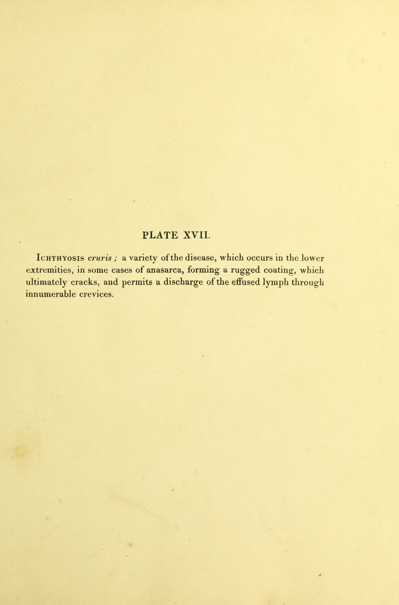 Ichthyosis cruris ; a variety of the disease, which occurs in the lower extremities, in some cases of anasarca, forming a rugged coating, which ultimately cracks, and permits a discharge of the effused lymph through innumerable crevices.