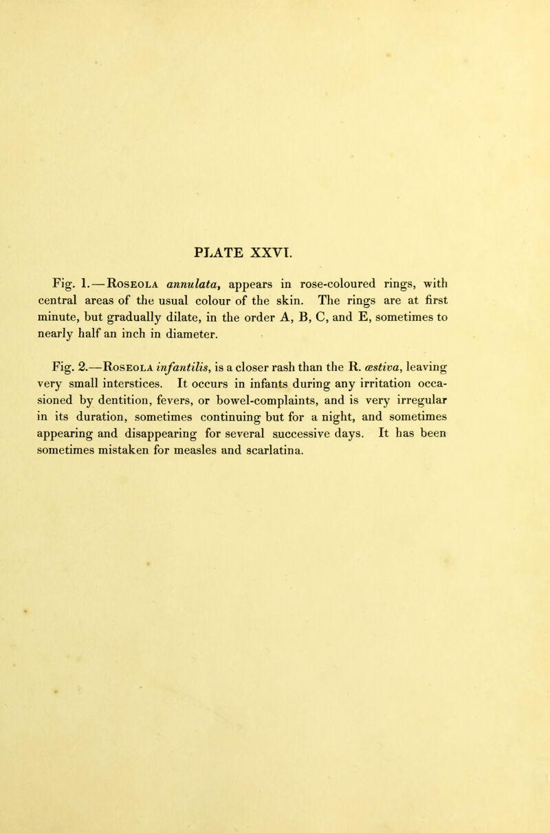 Fig. 1. — Roseola annulata, appears in rose-coloured rings, with central areas of the usual colour of the skin. The rings are at first minute, but gradually dilate, in the order A, B, C, and E, sometimes to nearly half an inch in diameter. Fig. 2.—Roseola infantilis, is a closer rash than the R. cestiva, leaving very small interstices. It occurs in infants during any irritation occa- sioned by dentition, fevers, or bowel-complaints, and is very irregular in its duration, sometimes continuing but for a night, and sometimes appearing and disappearing for several successive days. It has been sometimes mistaken for measles and scarlatina.