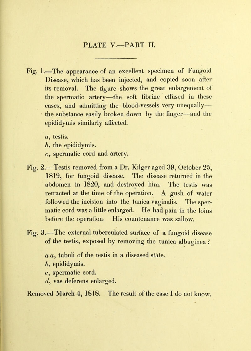 Fig. 1.—The appearance of an excellent specimen of Fungoid Disease, which has been injected, and copied soon after its removal. The figure shows the great enlargement of the spermatic artery—the soft fibrine effused in these cases, and admitting the blood-vessels very unequally— the substance easily broken down by the finger—and the epididymis similarly affected. a, testis. b9 the epididymis. e, spermatic cord and artery. Fig. 2.—Testis removed from a Dr. Kilger aged 39, October 25, 1819, for fungoid disease. The disease returned in the abdomen in 1820, and destroyed him. The testis was retracted at the time of the operation. A gush of water followed the incision into the tunica vaginalis. The sper- matic cord was a little enlarged. He had pain in the loins before the operation. His countenance was sallow. Fig. 3.—The external tuberculated surface of a fungoid disease of the testis, exposed by removing the tunica albuginea : aa9 tubuli of the testis in a diseased state. &, epididymis, e, spermatic cord. vas deferens enlarged.