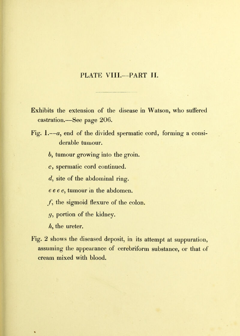 Exhibits the extension of the disease in Watson, who suffered castration.—See page 206. Fig. 1.—<z, end of the divided spermatic cord, forming a consi- derable tumour. 6, tumour growing into the groin. c, spermatic cord continued. site of the abdominal ring. eeee^ tumour in the abdomen. the sigmoid flexure of the colon. <7, portion of the kidney. h, the ureter. Fig. 2 shows the diseased deposit, in its attempt at suppuration, assuming the appearance of cerebriform substance, or that of cream mixed with blood.