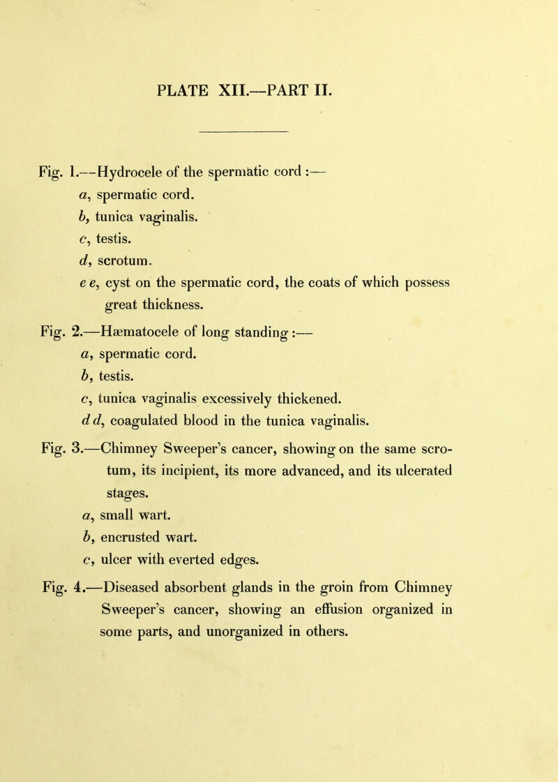 1. —Hydrocele of the spermatic cord :— spermatic cord. b, tunica vaginalis. <?, testis. d9 scrotum. e e9 cyst on the spermatic cord, the coats of which possess great thickness. 2. —Hematocele of long standing:— a9 spermatic cord. b9 testis. c9 tunica vaginalis excessively thickened. dd, coagulated blood in the tunica vaginalis. 3. —Chimney Sweeper's cancer, showing on the same scro- tum, its incipient, its more advanced, and its ulcerated stages. a9 small wart. b, encrusted wart. c9 ulcer with everted edges. 4. —Diseased absorbent glands in the groin from Chimney Sweeper's cancer, showing an effusion organized in some parts, and unorganized in others.