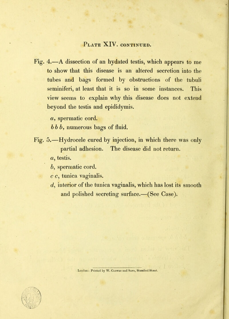 Plate XIV. continued. Fig. 4.—A dissection of an hydated testis, which appears to me to show that this disease is an altered secretion into the tubes and bags formed by obstructions of the tubuli seminiferi, at least that it is so in some instances. This view seems to explain why this disease does not extend beyond the testis and epididymis. spermatic cord. bbb9 numerous bags of fluid. Fig. 5.—Hydrocele cured by injection, in which there was only partial adhesion. The disease did not return. 0, testis. spermatic cord. c c, tunica vaginalis. d, interior of the tunica vaginalis, which has lost its smooth and polished secreting surface.—(See Case). London : Printed by W. Clowes and Sons, Stamford Street.