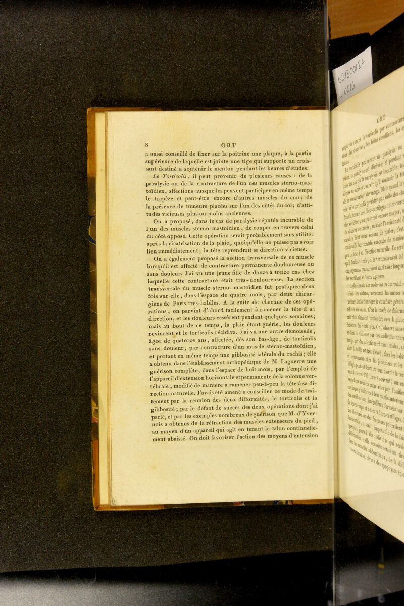 a aussi conseillé de fixer sur la poitrine une plaque, à la partie supérieure de laquelle est jointe une tige qui supporte un crois- sant destiné à soutenir le menton pendant les heures d'études. Le Torticolis ; il peut provenir de plusieurs causes : de la paralysie ou de la cbnlraclure de l'un des muscles sterno-mas- toïdien, affections auxquelles peuvent participer en même temps le trapèze et peut-être encore d'autres muscles du cou ; de la présence de tumeurs placées sur l'un des côtés du col 5 d'atti- tudes vicieuses plus ou moins anciennes. On a proposé, dans le cas de paralysie réputée incurable de l'un des muscles sterno-mastoïdien, de couper en travers celui du côté opposé. Cette opération serait probablement sans utilité : après la cicatrisation de la plaie, quoiqu'elle ne puisse pas avoir lieu immédiatement, la tête reprendrait sa direction vicieuse. On a également proposé la section transversale de ce muscle lorsqu'il est affecté de contracture permanente douloureuse ou sans douleur. J'ai vu une jeune fille de douze à treize ans chez laquelle cette contracture était très-douloureuse. La section transversale du muscle sterno-mastoïdien fut pratiquée deux fois sur elle, dans l'espace de quatre mois, par deux chirur- giens de Paris très-habiles. A la suite de chacune de ces opé- rations , on parvint d'abord facilement à ramener la tête à sa direction, et les douleurs cessèrent pendant quelques semaines; mais au bout de ce temps, la plaie étant guérie, les douleurs revinrent et le torticolis récidiva. J'ai vu une autre demoiselle , âgée de quatorze ans, affectée, dès son bas-âge, de torticolis sans douleur, par contracture d'un muscle sterno-mastoïdien, et portant en même temps une gibbosité latérale du rachis ; elle a obtenu dans l'établissement orthopédique de M. Laguerre une guérison complète, dans l'espace de huit mois, par l'emploi de l'appareil d'extension horizontale et permanente delà colonne ver- tébrale , modifié de manière à ramener peu-à-peu la tête à sa di- rection naturelle. J'avais été amené à conseiller ce mode de trai- tement par la réunion des deux difformités, le torticolis et la gibbosité ; par le défaut de succès des deux opérations dont j'ai parlé, et par les exemples nombreux de guérison que M. d'Yver- nois a obtenus de la rétraction des muscles extenseurs du pied , au moven d'un appareil qui agit en tenant le talon continuelle- ment abaissé. On doit favoriser l'action des moyens d'extension