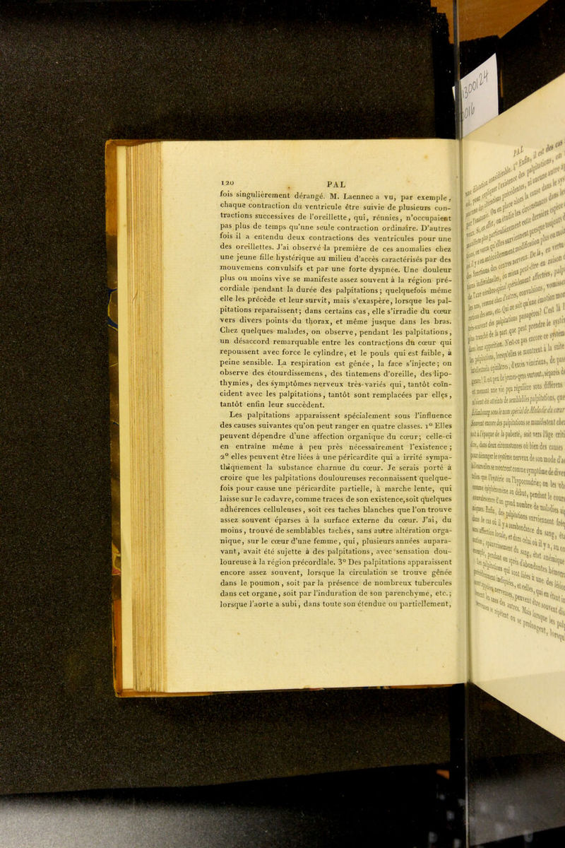 PAL fois singulièrement dérangé. M. Laennec a vu, par exemple, chaque contraction du venlricule être suivie de plusieurs con- tractions successives de l'oreillette, qui, réunies, n'occupaient pas plus de temps qu'une seule contraction ordinaire. D'autres fois il a entendu deux contractions des ventricules pour une des oreillettes. J'ai observé la première de ces anomalies chez une jeune fille hystérique au milieu d'accès caractérisés par des mouvemens convulsifs et par une forte dyspnée. Une douleur plus ou moins vive se manifeste assez souvent à la région pré- cordiale pendant la durée des palpitations; quelquefois même elle les précède et leur survit, mais s'exaspère, lorsque les pal- pitations reparaissent; dans certains cas, elle s'irradie du cœur vers divers points du thorax, et même jusque dans les bras. Chez quelques malades, on observe, pendant les palpitations, un désaccord remarquable entre les contractions du cœur qui repoussent avec force le cylindre, et le pouls qui est faible, à peine sensible. La respiration est gênée, la face s'injecte; on observe des étourdissemens, des tintemens d'oreille, des lipo- thymies, des symptômes nerveux très-variés qui, tantôt coïn- cident avec les palpitations, tantôt sont remplacées par elles, tantôt enfin leur succèdent. Les palpitations apparaissent spécialement sous l'influence des causes suivantes qu'on peut ranger en quatre classes. i° Elles peuvent dépendre d'une affection organique du cœur; celle-ci en entraîne même à peu près nécessairement Texistence ; 2° elles peuvent être liées à une péricardite qui a irrité syrapa- tliiquement la substance charnue du cœur. Je serais porté à croire que les palpitations douloureuses reconnaissent quelque- fois pour cause une péricardite partielle, à marche lente, qui laisse sur le cadavre, comme traces de son existence,soit quelques adhérences celluleuses, soit ces taches blanches que l'on trouve assez souvent éparses à la surface externe du cœur. J'ai, du moins , trouvé de semblables taches, sans autre altération orga- nique, sur le cœur d'une femme, qui, plusieurs années aupara- vant, avait été sujette à des palpitations, avec sensation dou- loureuse à la région précordiale. 3° Des palpitations apparaissent encore assez souvent, lorsque la circulation se trouve gênée dans le poumon, soit par la présence de nombreux tubercules dans cet organe, soit par l'induration de son parenchyme, etc.; lorsque l'aorle a subi, dans toute sou étendue ou partiellement, (»s« Lien»' ..Jil''' . encore ce sy^te». ,,,te;,ppant»î^es'l' ..,.„„, i U suite passage^'' jeui prendre le s rtBCBaBt «ne vie pço régulière sonsàta n'aifflléléatleiByeseDiWjWfsp3lpi(alWDS,(Iiie ùki» josj/f m ifééilèdhiaàdu mr I iaml encore des palpilalions se nianfelenl clif i I soiiilepoiiiieiic la piiktlé, soit vers l'âge criti I <lïe,àiiideaicircoDsl.incesoùbiendes causes I P^nmnserlesyslèmeneneuidesonmoded'at I fcelbe«„atcon,.espptômededivct r'^«io»Ioca ^^^^^^ pal]