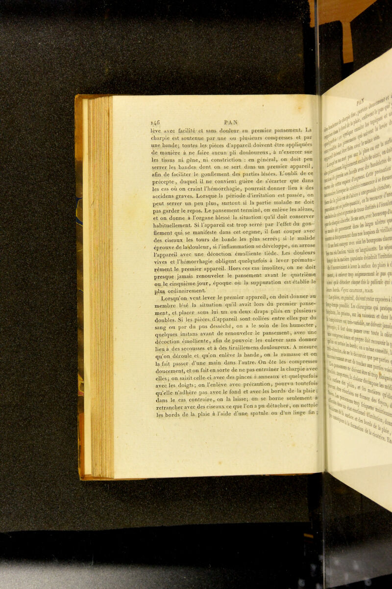 lève avec facilité et sans doujeur. au premier pansement. La charpie est soutenue par une ou plusieurs compresses et par une bande; toutes les pièces d'appareil doivent èlre appliquées de manière à ne faire aucun pli douloureux, à n'exercer sur les tissus ni, gène, ni conslriction : en général, on doit peu serrer les bandeSi dont on se sert dans un premier appareil, afin de faciliter le gonflement des parties lésées. L'oubli de ce précepte, duquel il ne convienl guère de s'écarter que dans les cas où on craint l'hémorrhagie, pourrait donner lieu à des accidens graves. Lorsque la période,d'irritation est passée, on peut serrer un peu plus, surtout si la partie malade ne doit pas garder le repos. Le pansement terminé, on enlève les alezes, et on donne à l'organe blessé la situation qu'il doit conserver habituellement. Si l'appareil est trop serré par l'effet du gon- flement qui se manifeste dans cet organe, il faut couper avec des ciseaux les tours de bande les plus serrés; si le malade éprouve de la douleur, si l'inflammation se développe, on arrose l'appareil avec une décoction émolliente tiède. Les douleurs vives et l'hémorrhagie obligent quelquefois à lever prématu- rément le premier appareil. Hors ces cas insolites, on ne doit presque jamais renouveler le pansement avant le quatrième ou. le cinquième jour, époque où la suppuration est établie le j^lflj) ordinairement. I^orsqu'on veut lever le premier appareil, on doit donner au membre lésé la situation qu'il avait lors du premier panse- ment, et placer sous lui uU; ou deux draps pliés en plusieurs doubles. Si les pièces, d'appareil sont collées entre elles par du sang ou par du pus desséché, on a le soin de les humecter, quelques instans avant de renouveler le pansement, avec une décoction émolliente, afin de pouvoir les enlever sans donner lieu à des secousses et à des tlraillemens douloureux. A mesure, qu'on déroule et qu'on enlève la bande, on la ramasse et on la fait passer d'une main dans l'autre. On ôte les compresses doucement, et on faiten sorte de ne pas entraîner la charpie avec elles,; on saisit celle-ci, avec des pinces à anneaux et quelquefois avec les doigts; on l'enlève avec précaution, pourvu toutefois- quelle n'adhère pas avec le fond et avec les bords de la plaie; dans le cas contraire, on la laisse; on se borne seulement à retrancher avec des ciseaux ce que l'on a pu détacher, on nettoie les bords de la plaie à l'aide d'une; spatide ou d'un linge fin ; des F Vf ace d'à niirâtio»f-''''' ,„:,ae trous ^ -avecsolntebourgeot^uWm lisanle. le sqoii àei'iBcoweBieBialamlasurfacedcsplMesicl mi, i enieier trop soi^neiisemcflt le pus qui m (p'i iéliàer ckipe (ois b jiêUe (jui i te kà l'ojc mmci, mil. I«pliies, fofé/iéral, doiveiil rester eiposces à 1 KMeœpspoALescfargiemquipratiqui il , pla 11 elle. état Sïtfa, foy ''fritjii.