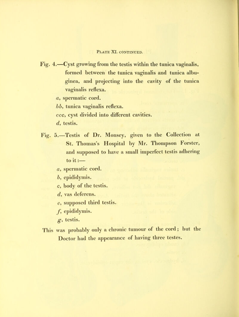 Plate XI. continued. Fig. 4.—Cyst growing from the testis within the tunica vaginalis, formed between the tunica vaginaHs and tunica albu- ginea, and projecting into the cavity of the tunica vaginahs reflexa. a, spermatic cord. bh, tunica vaginalis reflexa. ccc, cyst divided into different cavities. d, testis. Fig. 5.—Testis of Dr. Monsey, given to the Collection at St. Thomas's Hospital by Mr. Thompson Forster, and supposed to have a small imperfect testis adhering to it:— a, spermatic cord. h, epididymis. c, body of the testis. d, vas deferens. e, supposed third testis. f, epididymis. g, testis. This was probably only a chronic tumour of the cord; but the Doctor had the appearance of having three testes.