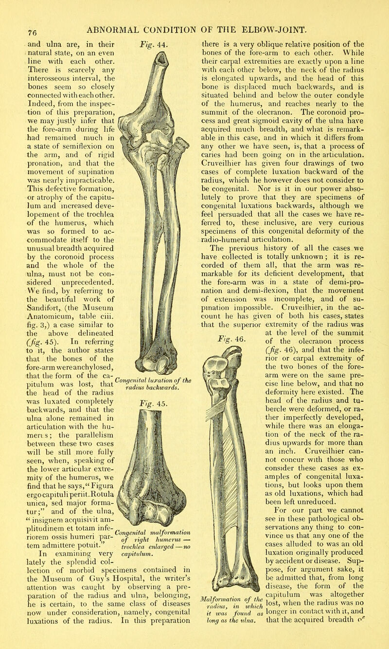 and ulna are, in their natural state, on an even line with each other. There is scarcely any interosseous interval, the bones seem so closely connected with each other. Indeed, from the inspec- tion of this preparation, we may justly infer that the fore-arm during life had remained much in a state of semiflexion on the arm, and of rigid pronation, and that the movement of supination was nearly impracticable. This defective formation, or atrophy of the capitu- lum and increased deve- lopement of the trochlea of the humerus, which was so formed to ac- commodate itself to the unusual breadth acquired by the coronoid process and the whole of the ulna, must not be con- sidered unprecedented. We find, by referring to the beautiful work of Sandifort, (the Museum Anatomicum, table ciii. fig. 3,) a case similar to the above delineated (fig. 45). In referring to it, the author states that the bones of the fore-arm were anchylosed, that the form of the ca pitulum was the head of the radius ■was luxated completely backwards, and that the ulna alone remained in articulation with the hu- meri s; the parallelism between these two cases will be still more fully seen, when, speaking of the lower articular extre- mity of the humerus, we . ; Congenital luxation of the lost, tnat Tadius backlvarfom Fig. 45. ■ ' IP 111 k it find that he says, Figura A ergocapituliperiil.Rotula /llOHMHB|>t unica, sed major forma- I^J^^|' tur; and of the ulna,  insignem acquisivit am- plitudinem et totam infe- , r. . , Vonqemtal malformation norem ossis humeri par- »f HgU hJumerm _ tem admittere potuit. trochlea enlarged—no In examining very capitulum. lately the splendid col- lection of morbid specimens contained in the Museum of Guy's Hospital, the writer's attention was caught by observing a pre- paration of the radius and ulna, belonging, he is certain, to the same class of diseases now under consideration, namely, congenital luxations of the radius. In this preparation there is a very oblique relative position of the bones of the fore-arm to each other. While their carpal extremities are exactly upon a line with each other below, the neck of the radius is elongated upwards, and the head of this bone is displaced much backwards, and is situated behind and below the outer condyle of the humerus, and reaches nearly to the summit of the olecranon. The coronoid pro- cess and great sigmoid cavity of the ulna have acquired much breadth, and what is remark- able in this case, and in which it differs from any other we have seen, is, that a process of caries had been going on in the articulation. Cruveilhier has given four drawings of two cases of complete luxation backward of the radius, which he however does not consider to be congenital. Nor is it in our power abso- lutely to prove that they are specimens of congenital luxations backwards, although we feel persuaded that all the cases we have re- ferred to, these inclusive, are very curious specimens of this congenital deformity of the radio-humeral articulation. The previous history of all the cases we have collected is totally unknown; it is re- corded of them all, that the arm was re- markable for its deficient development, that the fore-arm was in a state of demi-pro- nation and demi-flexion, that the movement of extension was incomplete, and of su- pination impossible. Cruveilhier, in the ac- count he has given of both his cases, states that the superior extremity of the radius was at the level of the summit of the olecranon process (Jig- 46), and that the infe- rior or carpal extremity of the two bones of the fore- arm were on the same pre- cise line below, and that no deformity here existed. The head of the radius and tu- bercle were deformed, or ra- ther imperfectly developed, while there was an elonga- tion of the neck of the ra- dius upwards for more than an inch. Cruveilhier can- not concur with those who consider these cases as ex- amples of congenital luxa- tions, but looks upon them as old luxations, which had been left unreduced. For our part we cannot see in these pathological ob- servations any thing to con- vince us that any one of the cases alluded to was an old luxation originally produced by accident or disease. Sup- pose, for argument sake, it be admitted that, from long disease, the form of the , capitulum was altogether Malformation of the j £ fa t, d; nQ radius, in winch , > ... , it was found as longer m contact with it, and long as the ulna, that the acquired breadth of Fig. 46. 1