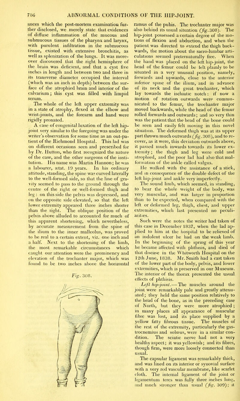 ances which the post-mortem examination fur- ther disclosed, we merely state that evidences of diffuse inflammation of the mucous and submucous tissues of the pharynx and larynx, with purulent infiltration in the submucous tissue, existed with extensive bronchitis, as well as splenization of the lungs. It was more- over discovered that the right hemisphere of the brain was deficient, and that a cyst five inches in length and between two and three in its transverse diameter occupied the interval (which was an inch in depth) between the sur- face of the atrophied brain and interior of the calvarium; this cyst was filled with limpid serum. The whole of the left upper extremity was in a state of atrophy, flexed at the elbow and wrist-joints, and the forearm and hand were rigidly pronated. A case of congenital luxation of the left hip- joint very similar to the foregoing was under the writer's observation for some time as an out-pa- tient of the Richmond Hospital. This lad was on different occasions seen and prescribed for by Dr. Ilutton, who first recognized the nature of the case, and the other surgeons of the insti- tution. His name was Martin Hannon; he was a labourer, setat. 19 years. In his ordinary attitude, standing, the spine was curved laterally to the well-formed side, so that the line of gra- vity seemed to pass to the ground through the centre of the right or well-formed thigh and leg : on this side the pelvis was depressed, and on the opposite side elevated, so that the left lower extremity appeared three inches shorter than the right. The oblique position of the pelvis above alluded to accounted for much of this apparent shortening, which nevertheless, by accurate measurement from the spine of the ilium to the inner malleolus, was proved to be real to a certain extent, viz. one inch and a half. Next to the shortening of the limb, the most remarkable circumstances which caught our attention were the prominency and elevation of the trochanter major, which was found to be two inches above the horizontal Fig. 308. ramus of the pubis. The trochanter major was also behind its usual situation (Jig. 308). The hip-joint possessed a certain degree of the mo- tions of flexion and abduction, and when the patient was directed to extend the thigh back- wards, the motion about the sacro-lumbar arti- culations seemed preternaturally free. When the hand was placed on the left hip-joint, the head of the femur could be felt plainly to be situated in a very unusual position, namely, forwards and upwards, close to the anterior inferior spine of the ilium, and in advance of its neck and the great trochanter, which lay towards the ischiatic notch: if now a motion of rotation outwards were commu- nicated to the femur, the trochanter major moved backwards, while the head of the femur rolled forwards and outwards; and so very thin was the patient that the head of the bone could be seen and easily felt moving in this novel situation. The deformed thigh was at its upper part thrown much outwards (jig. 308), and to re- cover, as it were, this deviation outwards above, it passed much inwards towards its lower ex- tremity; the thigh and leg were cold and atrophied, and the poor lad had also that mal- formation of the ankle called valgus. He walked with the assistance of a stick, and in consequence of the double defect of the left hip-joint and ankle very imperfectly. The sound limb, which seemed, in standing, to bear the whole weight of the body, was very muscular, and was larger in proportion than to be expected, when compared with the left or deformed leg, thigh, chest, and upper extremities, which last presented no peculi- arities. Such were the notes the writer had taken of this case in December 1837, when the lad ap- plied to him at the hospital to be relieved of an indolent ulcer he had on the weak limb. In the beginning of the spring of this year he became affected with phthisis, and died of that disease in the VVhitworth Hospital on the 12th June, 1838. Mr. Smith had a cast taken of the lower part of the body, pelvis, and lower extremities, which is preserved in our Museum. The interior of the thorax presented the usual effects of phthisis. Left hip-joint.— The muscles around the joint were remarkably pale and greatly attenu- ated ; they held the same position relatively to the head of the bone, as in the preceding case of North, but they were more atrophied; in many places all appearance of muscular fibre was lost, and its place supplied by a yellow fatty fibrous tissue. The muscles of the rest of the extremity, particularly the gas- trocnemius and solceus, were in a similar con- dition. The sciatic nerve had not a very healthy aspect; it was yellowish; and its fibres, though firm, were more loosely connected than usual. The capsular ligament was remarkably thick, and was lined on its interior or synovial surface with a very red vascular membrane, like scarlet cloth. The internal ligament of the joint or ligamentum teres was fully three inches long, and much stronger than usual (Jig. 309); it