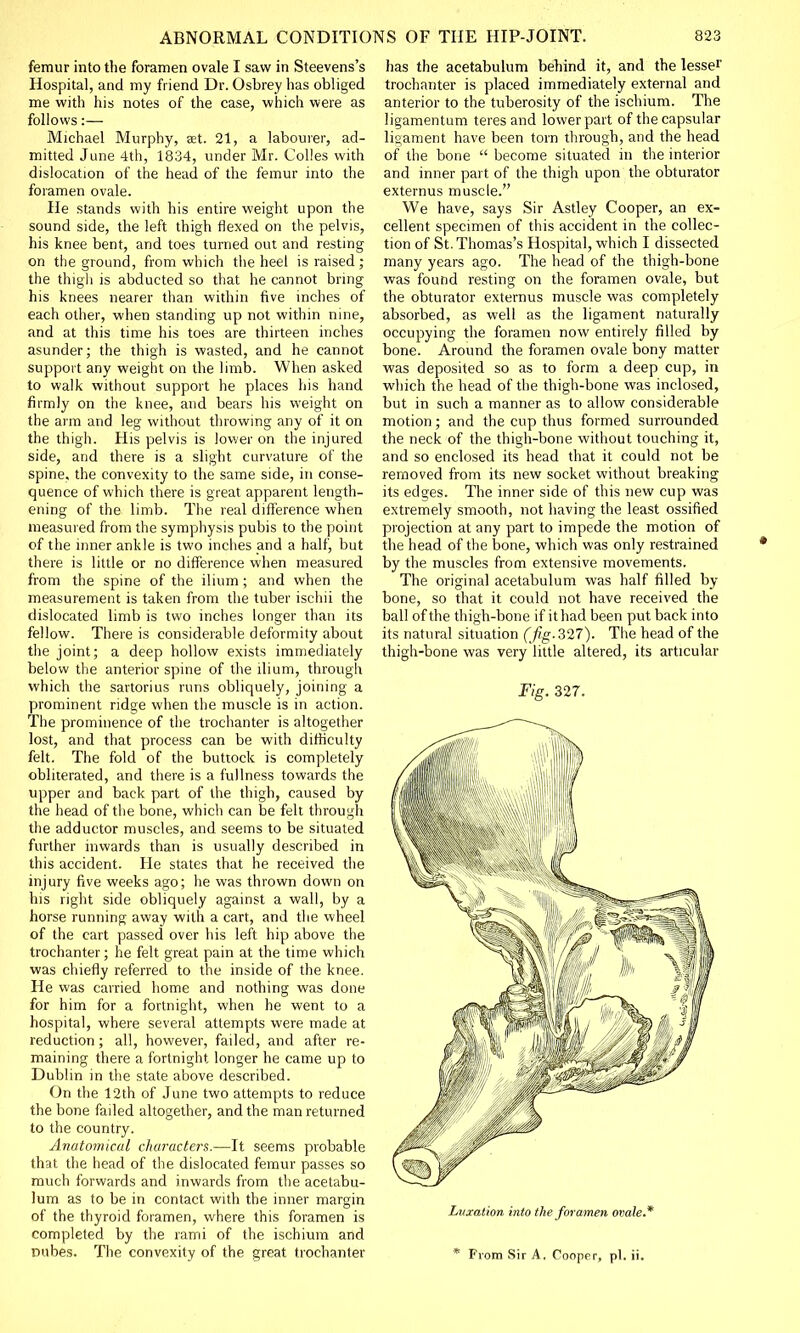 femur into the foramen ovale I saw in Steevens's Hospital, and my friend Dr. Osbrey has obliged me with his notes of the case, which were as follows:— Michael Murphy, at. 21, a labourer, ad- mitted June 4th, 1834, under Mr. Colles with dislocation of the head of the femur into the foramen ovale. He stands with his entire weight upon the sound side, the left thigh flexed on the pelvis, his knee bent, and toes turned out and resting on the ground, from which the heel is raised ; the thigh is abducted so that he cannot bring his knees nearer than within five inches of each other, when standing up not within nine, and at this time his toes are thirteen inches asunder; the thigh is wasted, and he cannot support any weight on the limb. When asked to walk without support he places his hand firmly on the knee, and bears his weight on the arm and leg without throwing any of it on the thigh. His pelvis is lower on the injured side, and there is a slight curvature of the spine, the convexity to the same side, in conse- quence of which there is great apparent length- ening of the limb. The real difference when measured from the symphysis pubis to the point of the inner ankle is two inches and a half, but there is little or no difference when measured from the spine of the ilium ; and when the measurement is taken from the tuber ischii the dislocated limb is two inches longer than its fellow. There is considerable deformity about the joint; a deep hollow exists immediately below the anterior spine of the ilium, through which the sartorius runs obliquely, joining a prominent ridge when the muscle is in action. The prominence of the trochanter is altogether lost, and that process can be with difficulty felt. The fold of the buttock is completely obliterated, and there is a fullness towards the upper and back part of the thigh, caused by the head of the bone, which can be felt through the adductor muscles, and seems to be situated further inwards than is usually described in this accident. He states that he received the injury five weeks ago; he was thrown down on his right side obliquely against a wall, by a horse running away with a cart, and the wheel of the cart passed over his left hip above the trochanter; lie felt great pain at the time which was chiefly referred to the inside of the knee. He was carried home and nothing was done for him for a fortnight, when he went to a hospital, where several attempts were made at reduction; all, however, failed, and after re- maining there a fortnight longer he came up to Dublin in the state above described. On the 12th of June two attempts to reduce the bone failed altogether, and the man returned to the country. Anatomical characters.—It seems probable that the head of the dislocated femur passes so much forwards and inwards from the acetabu- lum as to be in contact with the inner margin of the thyroid foramen, where this foramen is completed by the rami of the ischium and Dubes. The convexity of the great trochanter has the acetabulum behind it, and the lesser trochanter is placed immediately external and anterior to the tuberosity of the ischium. The ligamentum teres and lower part of the capsular ligament have been torn through, and the head of the bone  become situated in the interior and inner part of the thigh upon the obturator externus muscle. We have, says Sir Astley Cooper, an ex- cellent specimen of this accident in the collec- tion of St. Thomas's Hospital, which I dissected many years ago. The head of the thigh-bone was found resting on the foramen ovale, but the obturator externus muscle was completely absorbed, as well as the ligament naturally occupying the foramen now entirely filled by bone. Around the foramen ovale bony matter was deposited so as to form a deep cup, in which the head of the thigh-bone was inclosed, but in such a manner as to allow considerable motion; and the cup thus formed surrounded the neck of the thigh-bone without touching it, and so enclosed its head that it could not be removed from its new socket without breaking its edges. The inner side of this new cup was extremely smooth, not having the least ossified projection at any part to impede the motion of the head of the bone, which was only restrained by the muscles from extensive movements. The original acetabulum was half filled by- bone, so that it could not have received the ball of the thigh-bone if it had been put back into its natural situation (fig. 327). The head of the thigh-bone was very little altered, its articular Fig. 327. Luxation into the foramen ovale. * From Sir A. Cooper, pi. ii.