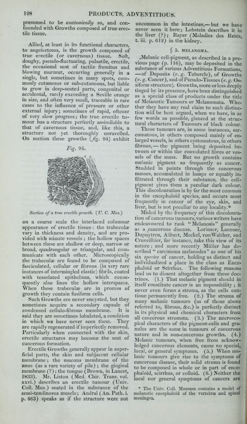 presumed to be anatomically so, and con- founded with Growths composed of true erec- tile tissue. Allied, at least in its functional characters, to angeiectoma, is the growth composed of true erectile (or cavernous) tissue. Soft, doughy, pseudo-fluctuating, pulsatile, erectile, the occasional seat of tactile fremitus and blowing murmur, occurring generally in a single, but sometimes in many spots, com- monly cutaneous or sub-cutaneous, but liable to grow in deep-seated parts, congenital or accidental, rarely exceeding a Seville orange in size, and often very small, traceable in rare cases to the influence of pressure or other external injury; sometimes of rapid, oftener of very slow progress; the true erectile tu- mour has a structure perfectly assimilable to that of cavernous tissue, and, like this, a structure not yet thoroughly unravelled. On section these growths {fig. 94) exhibit Fig. 94. Section of a true erectile growth, (t' C. JIus.) on a coarse scale the interlaced columnar appearance of erectile tissue: the trabeculae vary in thickness and density, and are pro- vided with minute vessels ; the hollow spaces between these are shallow or deep, narrow or broad, quadrangular or triangular, and com- municate with each other. Microscopically the trabeculte are found to be composed of fasciculated, cellular or fibrous (in very rare instances of intermingled elastic) fibrils, coated with tesselated epithelium, which conse- quently also lines the hollow interspaces. When these trabeculse are in process of growth they contain fusiform cells. Such Growths are never encysted, but they sometimes acquire a secondary capsule of condensed cellulo-fibrous membrane. It is said they are sometimes lobulated, a condition in which we have never seen them. They are rapidly regenerated if imperfectly removed. Particularly when connected with the skin, erectile structures may become the seat of cancerous formation. Erectile Grow ths generally appear in super- ficial parts, the skin and subjacent cellular membrane; the mucous membrane of the anus (as a rare variety of pile) ; the gingival membrane (?) ; the tongue (Brown, in Lancet, 1833). Mr. Listen (Med. Chir. Trans, vol. xxvi.) describes an erectile tumour (Univ. Coll. Mus.) seated in the substance of the semi-tendinosus muscle; Andral (An. Path. i. p. 463) speaks as if the structure were not uncommon in the intestines,— but we have never seen it here; Lobstein describes it in the liver (?); Rayer (Maladies des Reins, t. iii. p. 612) in the kidney. § 5. 31ELAX0MA. .Melanic cell-pigment, as described in a pre- vious page (p. 116), may be deposited in the substance of various Adventitious Formations, — of Deposits (e. g. Tubercle), of Growths (e. g. Cancer), and of Pseudo-Tissues (e.g. Os- siform structure). Grow ths, more or less deeply tinged by its presence, have been distinguished as a special class of products under the titla of jNIelanotic Tumours or Melanomata. Whe- ther they have any real claim to such distinc- tion will be best argued, when we have, in as few words as possible, glanced at the struc- tural characters of Tumours of black colour. These tumours are, in some instances, sar- comatous, in others composed mainly of en- larged vessels, in others cystomatous, in others fibrous, — the pigment being deposited be- tween or within the convoluted fibres or ves- sels of the mass. But no growth contains melanic pigment so frequently as cancer. Studded in points through the cancerous masses, accumulated in lumps or equably in- filtrated through their substance, the cell- pigment gives them a peculiar dark colour. This discolouration is by far the most common in the encephaloid species, and occurs most frequently in cancer of the eye, skin, and liver, but is not peculiar to any locality.* Misled by the frequency of this discoloura- tion of cancerous tumours, various writers have endeavoured to rank Melanosis generally as a cancerous disease. Lorinser, Laennec, Dupuytren, Alibert, Meckel, vonWalther, and Cruveilhier, for instance, take this view of its nature ; and more recently Miiller has de- scribed  carcmoma melanodes as one of his six species of cancer, holding as distinct and individualized a place in the class as Ence- phaloid or Scirrhus. The following reasons lead us to dissent altogether from these doc- trines. (1.) That melanic pigment should in itself constitute cancer is an impossibility ; it never even forms a stroma, as the cells con- tinue permanently free. (2.) The stroma of many melanic tumours (as of those above referred to, fibrous. Sec.) is perfectly distinct in its physical and chemical characters from all cancerous stromata. (3.) The microsco- pical characters of the pigment-cells and gra- nules are the same in tumours of cancerous nature and in non-cancerous growths. (4.) Melanic tumours, when free from acknow- ledged cancerous elements, cause no special, local, or general symptoms. (5.) When me- lanic tumours give rise to the symptoms of cancerous disease, their solid stroma is found to be composed in whole or in part of ence- phaloid, scirrhus, or colloid. (6.) Neither the local nor general symptoms of cancers are * The Univ. Coll. Museum contains a model of melanotic encephaloid of the vertebrae and spinal meninges.