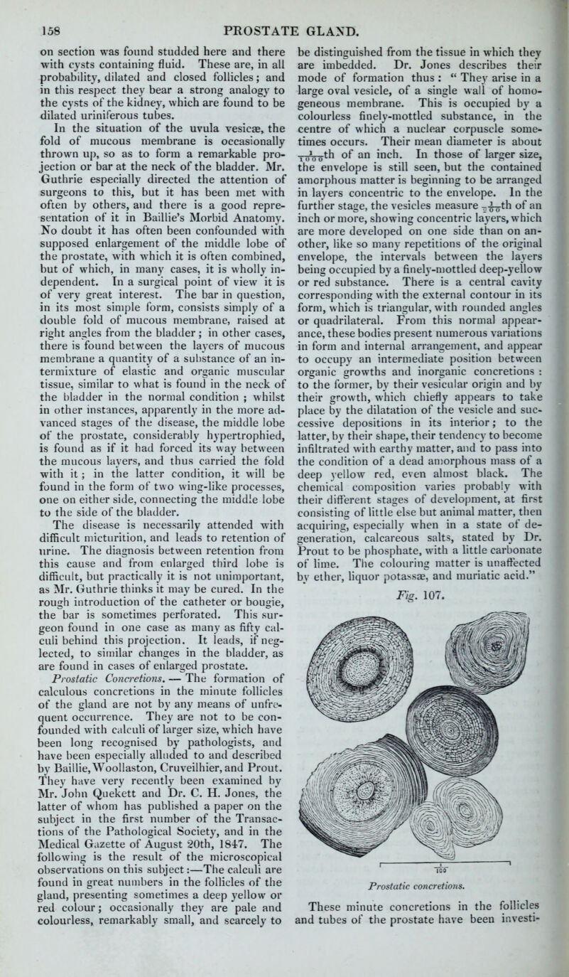 on section was found studded here and there with cysts containing fluid. These are, in all probability, dilated and closed follicles; and in this respect they bear a strong analogy to the cysts of the kidney, which are found to be dilated uriniferous tubes. In the situation of the uvula vesicae, the fold of mucous membrane is occasionally thrown up, so as to form a remarkable pro- jection or bar at the neck of the bladder. Mr. Guthrie especially directed the attention of surgeons to this, but it has been met with often by others, and there is a good repre- sentation of it in Baillie's Morbid Anatomy. No doubt it has often been confounded with supposed enlargement of the middle lobe of the prostate, with which it is often combined, but of which, in many cases, it is wholly in- dependent. In a surgical point of view it is of very great interest. The bar in question, in its most simj)le form, consists simply of a double fold of mucous membrane, raised at right angles from the bladder; in other cases, there is found between the layers of mucous membrane a quantity of a substance of an in- termixture of elastic and organic muscular tissue, similar to what is found in the neck of the bladder in the normal condition ; whilst in other instances, apparently in the more ad- vanced stages of the disease, the middle lobe of the prostate, consideral)ly hypertrophied, is found as if it had forced its way between the mucous layers, and thus carried the fold with it ; in the latter condition, it will be found in the form of two wing-like processes, one on either side, connecting the middle lobe to the side of the bladder. The disease is necessarily attended with difficult micturition, and leads to retention of urine. The diagnosis between retention from this cause and from enlarged third lobe is difficult, but practically it is not unimportant, as Mr. Guthrie thinks it may be cured. In the rough introduction of the catheter or bougie, the bar is sometimes perforated. This sur- geon found in one case as many as fifty cal- culi behind this projection. It leads, if neg- lected, to similar changes in the bladder, as are found in cases of enlarged prostate. Prostatic Concretions. — The formation of calculous concretions in the minute follicles of the gland are not by any means of unfre- quent occurrence. They are not to be con- founded with calculi of larger size, which have been long recognised by pathologists, and have been especially alluded to and described by Baillie,Woollaston, Cruveilhier, and Prout. They have very recently been examined by Mr. John Quekett and Dr. C. H. Jones, the latter of whom has published a paper on the subject in the first number of the Transac- tions of the Pathological Society, and in the Medical Gazette of August 20th, 1847. The following is the result of the microscopical observations on this subject:—The calculi are found in great numbers in the follicles of the gland, presenting sometimes a deep yellow or red colour; occasionally they are pale and colourless, remarkably small, and scarcely to be distinguished from the tissue in which they are imbedded. Dr. Jones describes their mode of formation thus :  They arise in a large oval vesicle, of a single wall of homo- geneous membrane. This is occupied by a colourless finely-mottled substance, in the centre of which a nuclear corpuscle some- times occurs. Their mean diameter is about YoVo^h of an inch. In those of larger size, the envelope is still seen, but the contained amorphous matter is beginning to be arranged in layers concentric to the envelope. In the further stage, the vesicles measure ^-^^th of an inch or more, showing concentric layers, which are more developed on one side than on an- other, like so many repetitions of the original envelope, the intervals between the layers being occupied by a finely-mottled deep-yellow or red substance. There is a central cavity corresponding with the external contour in its form, which is triangular, with rounded angles or quadrilateral. From this normal appear- ance, these bodies present numerous variations in form and internal arrangement, and appear to occupy an intermediate position between organic growths and inorganic concretions : to the former, by their vesicular origin and by their growth, which chiefly appears to take place by the dilatation of the vesicle and suc- cessive depositions in its interior; to the latter, by their shape, their tendency to become infiltrated with earthy matter, and to pass into the condition of a dead amorphous mass of a deep yellow red, even almost black. The chemical composition varies probably with their different stages of development, at first consisting of little else but animal matter, then acquiring, especially when in a state of de- generation, calcareous salts, stated by Dr. Prout to be phosphate, with a little carbonate of lime. The colouring matter is unaffected by ether, liquor potassae, and muriatic acid. Fig. 107. IC3 Prostatic concretions. These minute concretions in the follicles and tubes of the prostate have been investi-