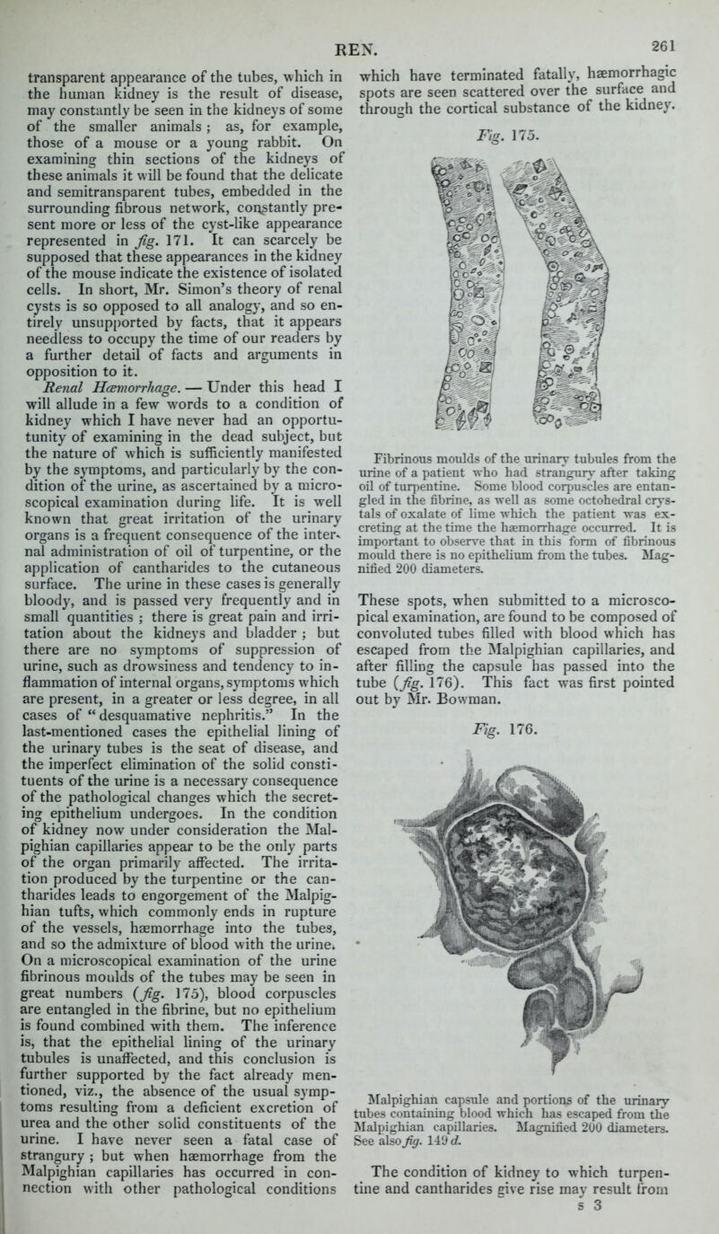 transparent appearance of the tubes, which in the human kidney is the result of disease, may constantly be seen in the kidneys of some of the smaller animals ; as, for example, those of a mouse or a young rabbit. On examining thin sections of the kidneys of these animals it will be found that the delicate and semitransparent tubes, embedded in the surrounding fibrous network, constantly pre- sent more or less of the cyst-like appearance represented in fig. 171. It can scarcely be supposed that these appearances in the kidney of the mouse indicate the existence of isolated cells. In short, Mr. Simon's theory of renal cysts is so opposed to all analogy, and so en- tirely unsupported by facts, that it appears needless to occupy the time of our readers by a further detail of facts and arguments in opposition to it. Renal Hcemorrhage. — Under this head I will allude in a few words to a condition of kidney which I have never had an opportu- tunity of examining in the dead subject, but the nature of which is sufficiently manifested by the symptoms, and particularly by the con- dition of the urine, as ascertained by a micro- scopical examination during life. It is well known that great irritation of the urinary organs is a frequent consequence of the inter- nal administration of oil of turpentine, or the application of cantharides to the cutaneous surface. The urine in these cases is generally bloody, and is passed very frequently and in small quantities ; there is great pain and irri- tation about the kidneys and bladder ; but there are no symptoms of suppression of urine, such as drowsiness and tendency to in- flammation of internal organs, symptoms which are present, in a greater or less degree, in all cases of  desquamative nephritis. In the last-mentioned cases the epithelial lining of the urinary tubes is the seat of disease, and the imperfect elimination of the solid consti- tuents of the urine is a necessary consequence of the pathological changes which the secret- ing epithelium undergoes. In the condition of kidney now under consideration the Mal- pighian capillaries appear to be the only parts of the organ primarily affected. The irrita- tion produced by the turpentine or the can- tharides leads to engorgement of the Malpig- hian tufts, which commonly ends in rupture of the vessels, hsemorrhage into the tubes, and so the admixture of blood with the urine* On a microscopical examination of the urine fibrinous moulds of the tubes may be seen in great numbers (^fig. 175), blood corpuscles are entangled in the fibrine, but no epithelium is found combined with them. The inference is, that the epithelial lining of the urinary tubules is unaffected, and this conclusion is further supported by the fact already men- tioned, viz., the absence of the usual symp- toms resulting from a deficient excretion of urea and the other solid constituents of the urine. I have never seen a fatal case of strangury ; but when haemorrhage from the Malpighian capillaries has occurred in con- nection with other pathological conditions which have terminated fatally, haemorrhagic spots are seen scattered over the surface and through the cortical substance of the kidney. Fig. 175. Fibrinous moulds of the urinary tubules from the urine of a patient who had strangurv' after taking oil of turpentine. Some hlood corpuscles are entan- gled in the fibrine, as well as some octohedral cr\-s- tals of oxalate of lime which the patient was ex- creting at the time the hjemorrhage occurred. It is important to observe that in this form of fibrinous mould there is no epithelium from the tubes. Mag- nified 200 diameters. These spots, when submitted to a microsco- pical examination, are found to be composed of convoluted tubes filled with blood which has escaped from the 3Ialpighian capillaries, and after filling the capsule has passed into the tube {fig. 176). This fact was first pointed out by Mr. Bowman. F\g. 176. INIalpighian capsule and portions of the urinary- tubes containing blood which has escaped from the Malpighian capillaries. Magnified 200 diameters. See also fig. 149 d. The condition of kidney to which turpen- tine and cantharides cive rise mav result from