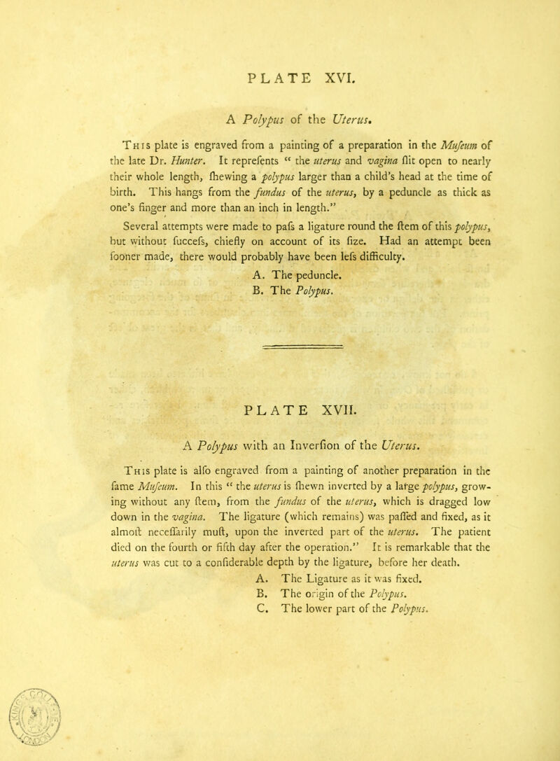 A Polypus of the Uterus. This plate is engraved from a painting of a preparation in the Mujeum of the late Dr. Hunter. It reprefents <c the uterus and vagina flit open to nearly their whole length, ffiewing a polypus larger than a child’s head at the time of birth. This hangs from the fundus of the uterus, by a peduncle as thick as one’s finger and more than an inch in length.” Several attempts were made to pafs a ligature round the ftem of this polypus, but without fuccefs, chiefly on account of its fize. Had an attempt been fooner made, there would probably have been lefs difficulty. A. The peduncle. B. The Polypus. PLATE XVII. A Polypus with an Inverfion of the Uterus. This plate is alfo engraved from a painting of another preparation in the fame Mujeum. In this “ the uterus is fhewn inverted by a large polypus, grow- ing without any ftem, from the fundus of the uterus, which is dragged low down in the vagina. The ligature (which remains) was pafied and fixed, as it almoft neceflarily muft, upon the inverted part of the uterus. The patient died on the fourth or fifth day after the operation.” It is remarkable that the uterus was cut to a confiderable depth by the ligature, before her death. A. The Ligature as it was fixed. B. The origin of the Polypus. C. The lower part of the Polypus.