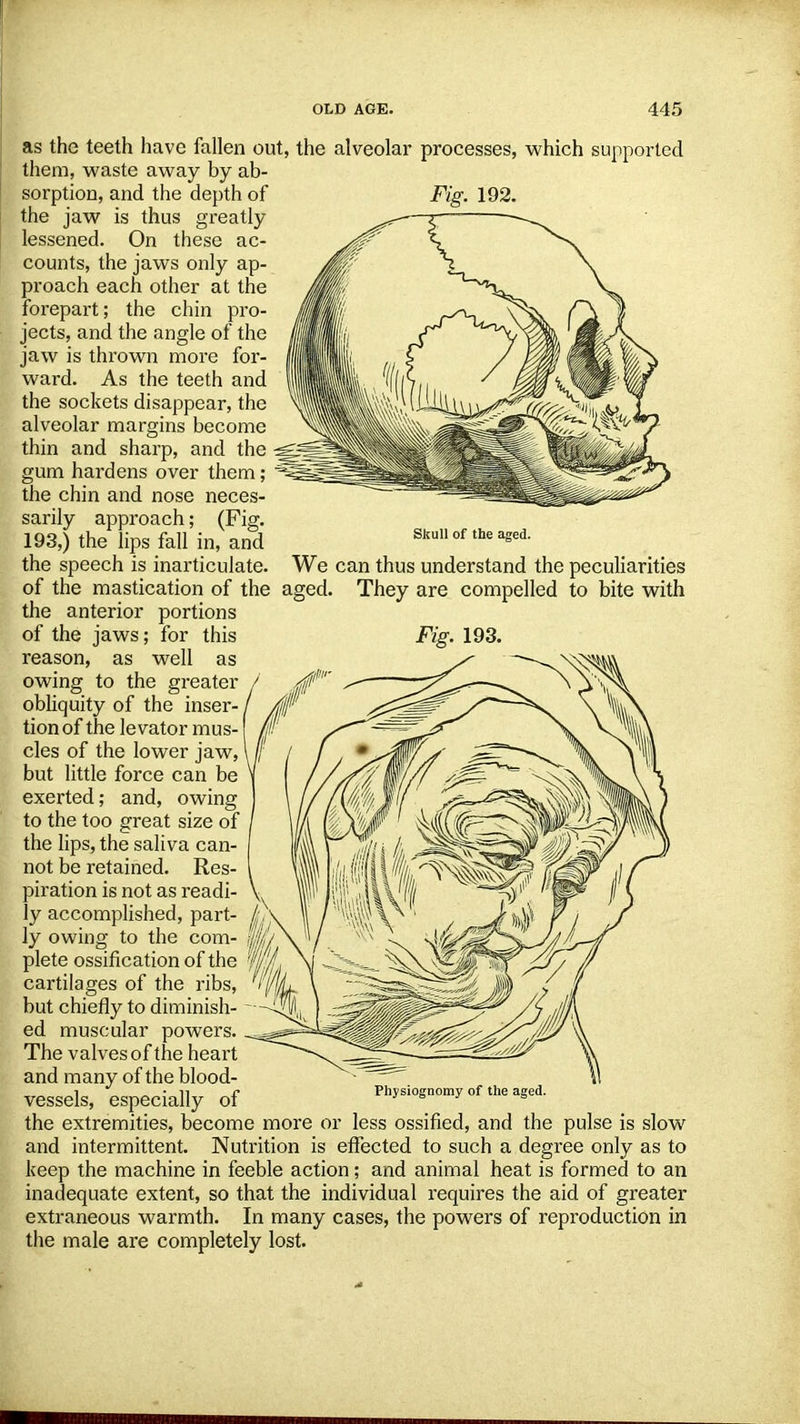 as the teeth have fallen out, the alveolar processes, which supported them, waste away by ab- Fig. 192. Skull of the aged. We can thus understand the peculiarities aged. They are compelled to bite with Fig. 193. sorption, and the depth of the jaw is thus greatly lessened. On these ac- counts, the jaws only ap- proach each other at the forepart; the chin pro- jects, and the angle of the jaw is thrown more for- ward. As the teeth and the sockets disappear, the alveolar margins become thin and sharp, and the gum hardens over them; the chin and nose neces- sarily approach; (Fig. 193,) the lips fall in, and the speech is inarticulate, of the mastication of the the anterior portions of the jaws; for this reason, as well as owing to the greater / obliquity of the inser- / tionof the levator mus cles of the lower jaw, \ lj but little force can be \ exerted; and, owing to the too great size of the lips, the saliva can- not be retained. Res- piration is not as readi- ly accomplished, part- ly owing to the com- plete ossification of the cartilages of the ribs, but chiefly to diminish- ed muscular powers. The valves of the heart and many of the blood- vessels, especially of the extremities, become more or less ossified, and the pulse is slow and intermittent. Nutrition is effected to such a degree only as to keep the machine in feeble action; and animal heat is formed to an inadequate extent, so that the individual requires the aid of greater extraneous warmth. In many cases, the powers of reproduction in the male are completely lost. Physiognomy of the aged.